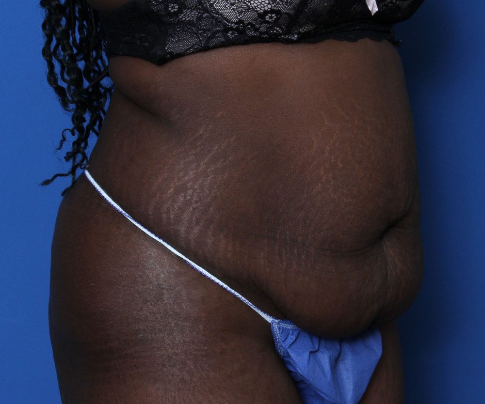 Tummy Tuck Patient Photo - Case 219 - before view-1