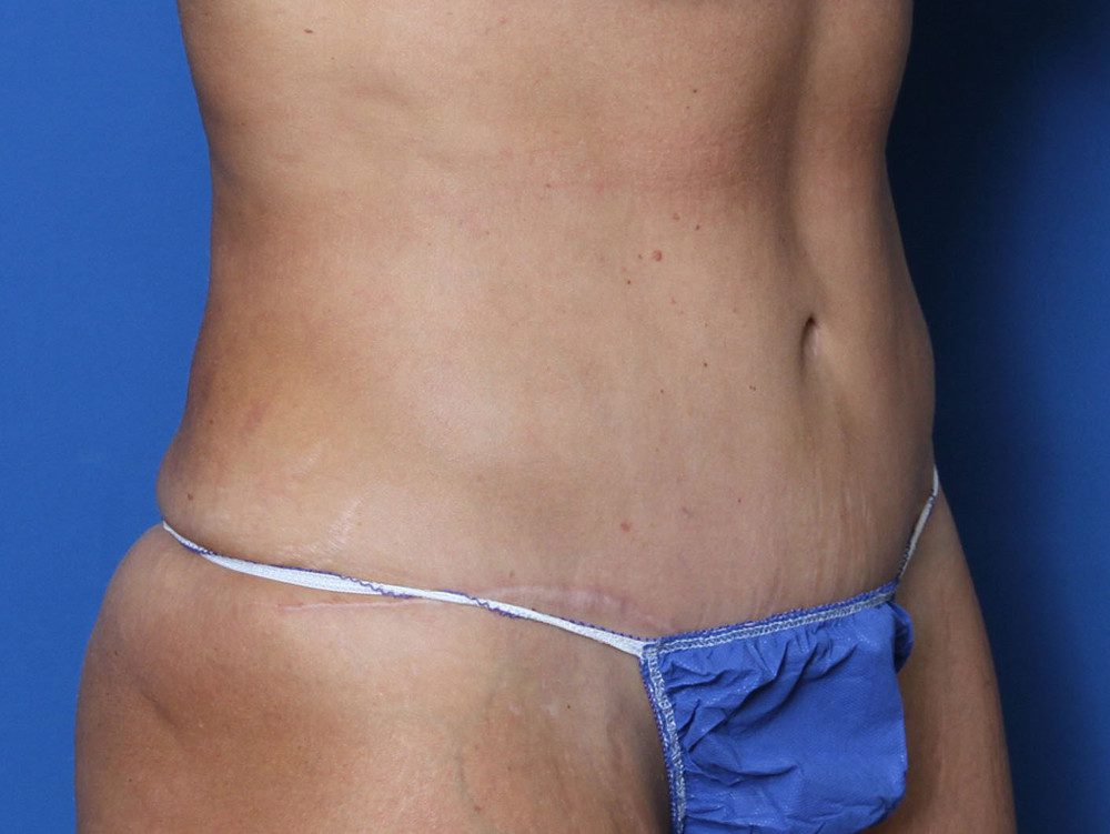 Tummy Tuck Patient Photo - Case 220 - after view-1