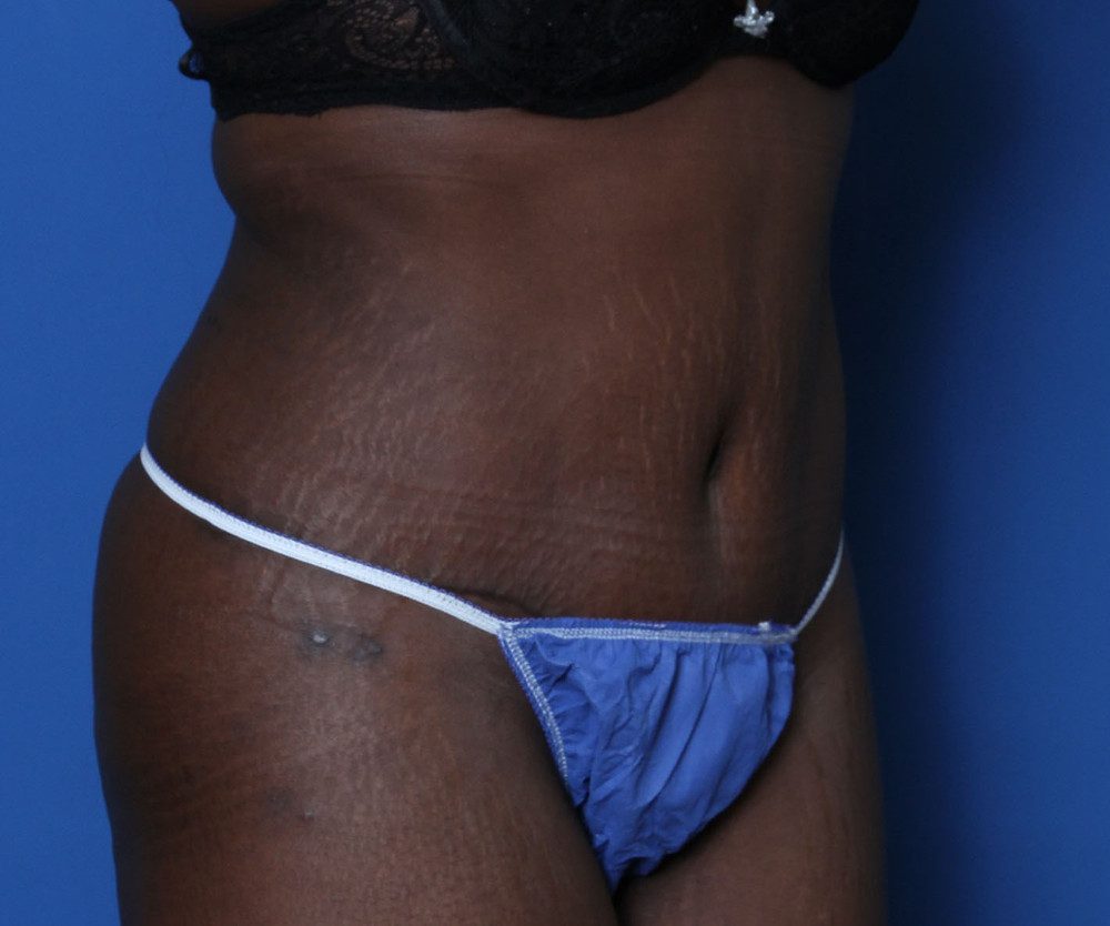 Tummy Tuck Patient Photo - Case 219 - after view-1