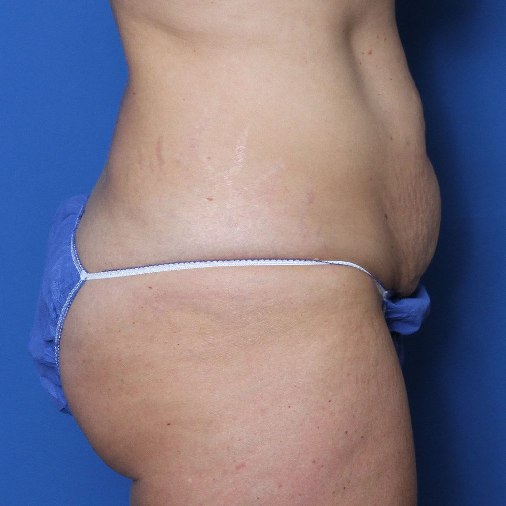 Tummy Tuck Patient Photo - Case 220 - before view-2
