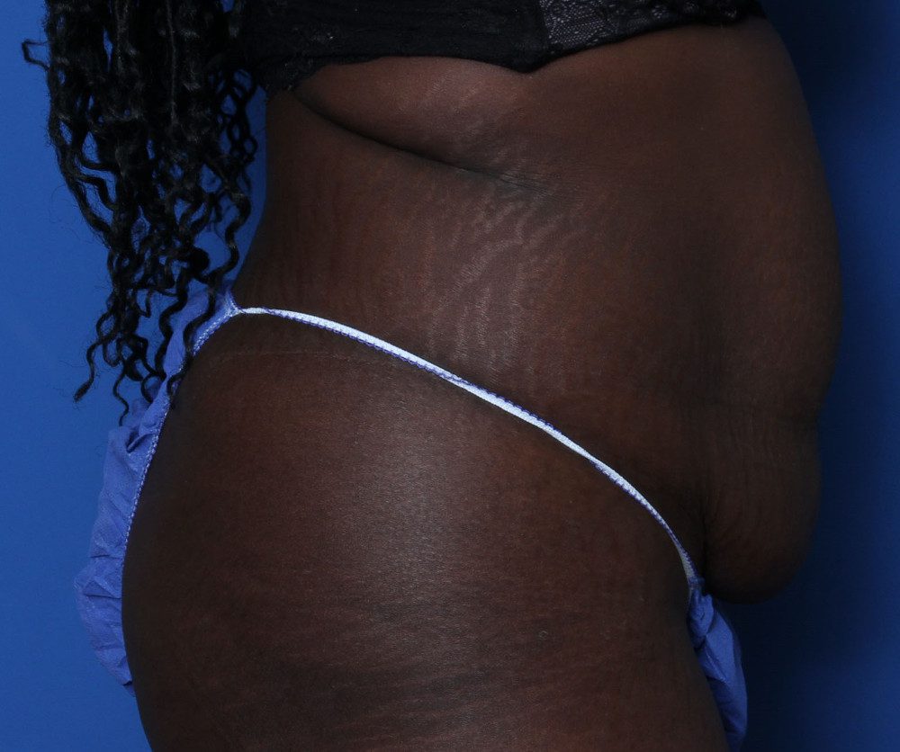 Tummy Tuck Patient Photo - Case 219 - before view-2
