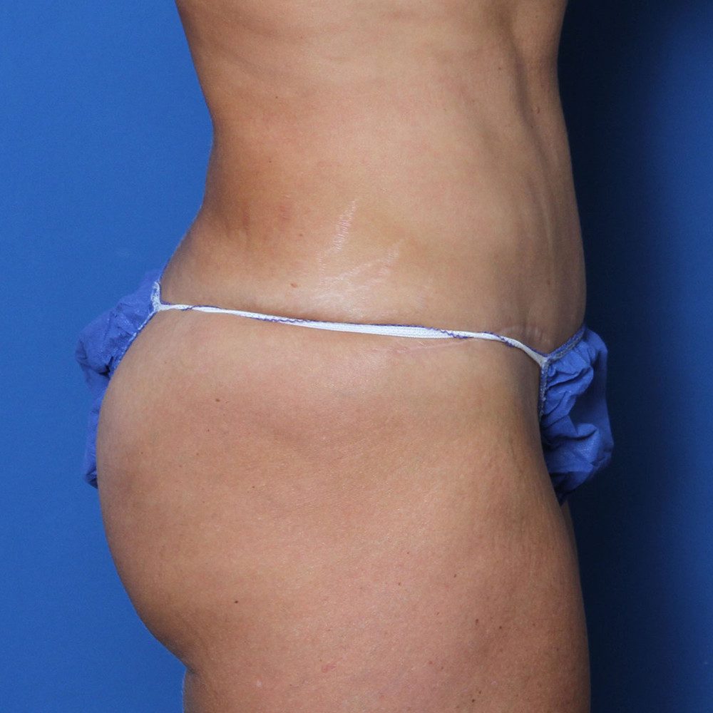 Tummy Tuck Patient Photo - Case 220 - after view-2