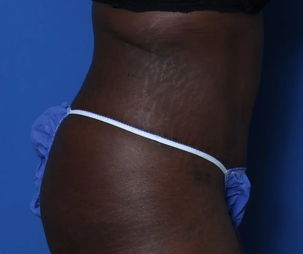 Tummy Tuck Patient Photo - Case 219 - after view-2