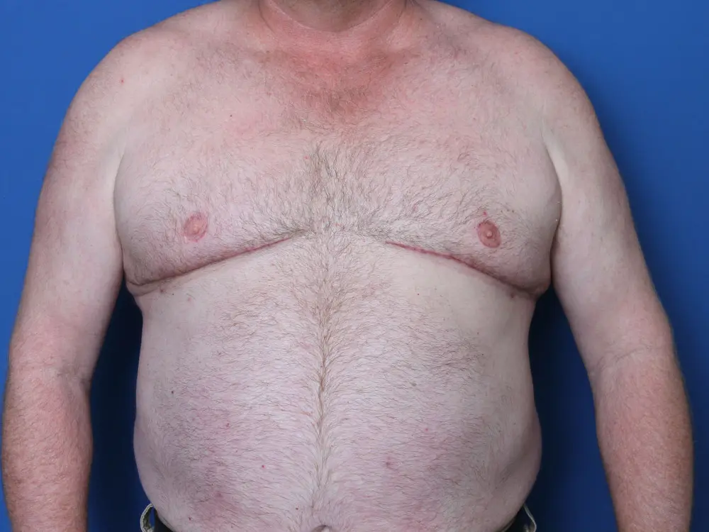 Gynecomastia/Male Chest Lift - Case 224 - After