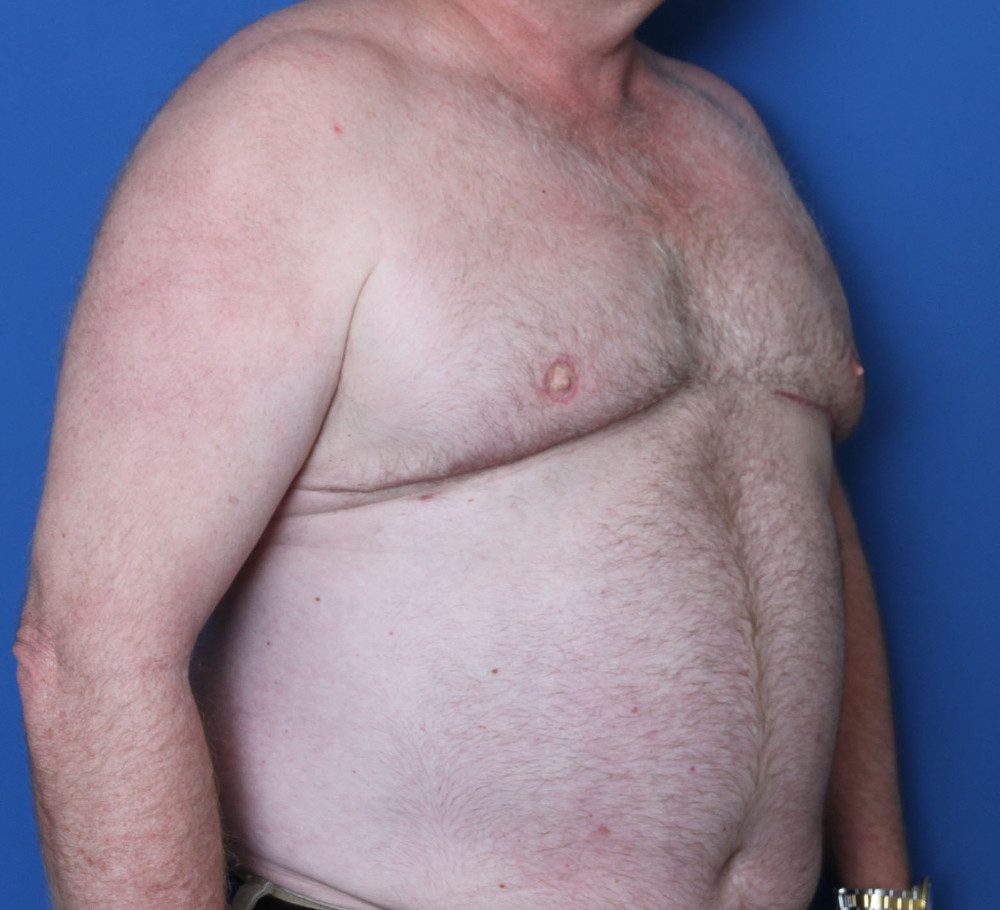 Gynecomastia Patient Photo - Case 224 - after view-1
