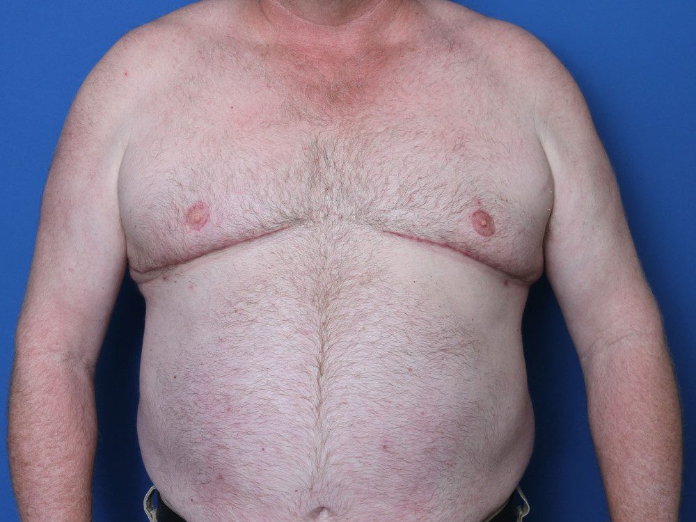 Gynecomastia Patient Photo - Case 224 - after view-2