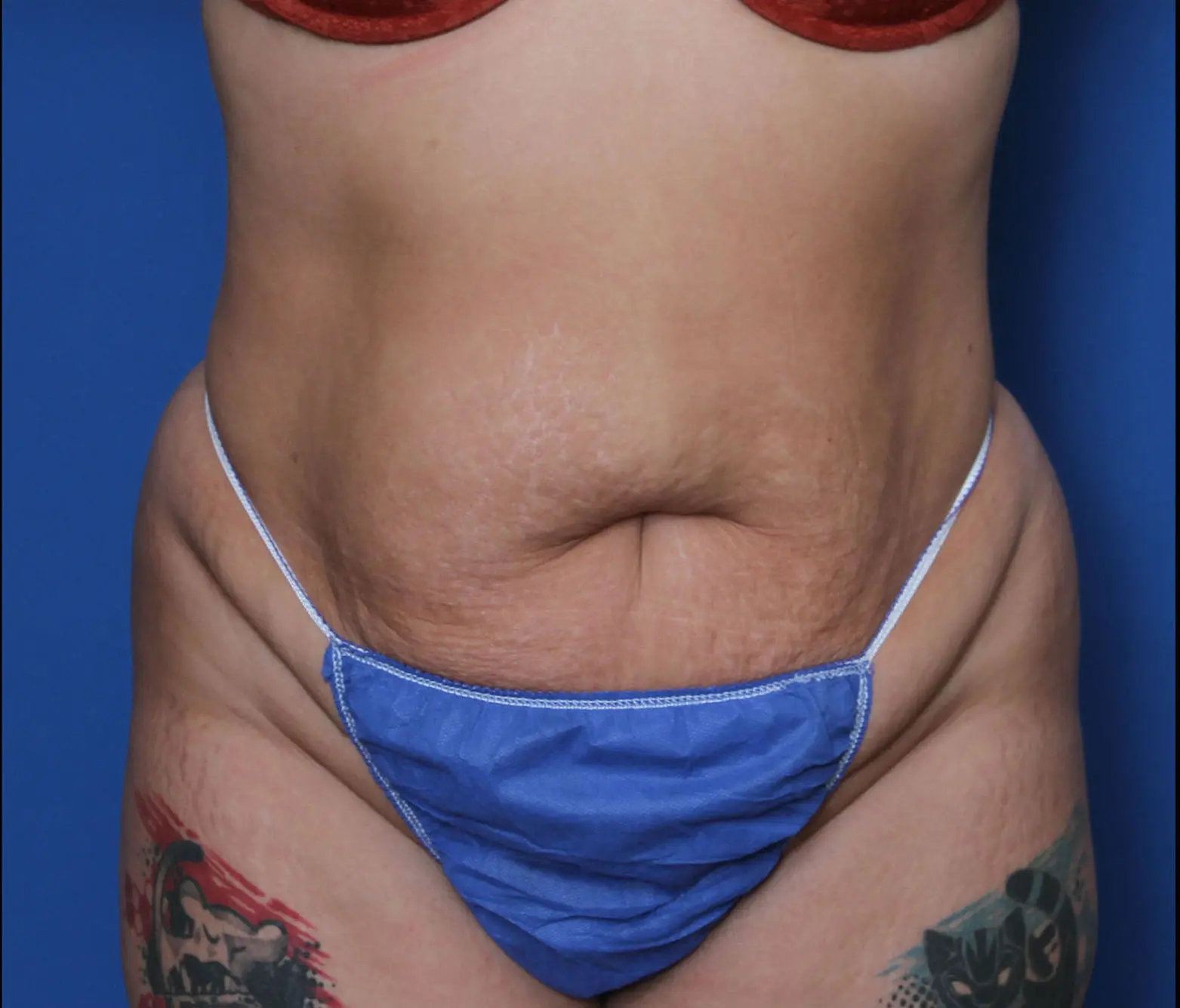Tummy Tuck Patient Photo - Case 5534 - before view-0