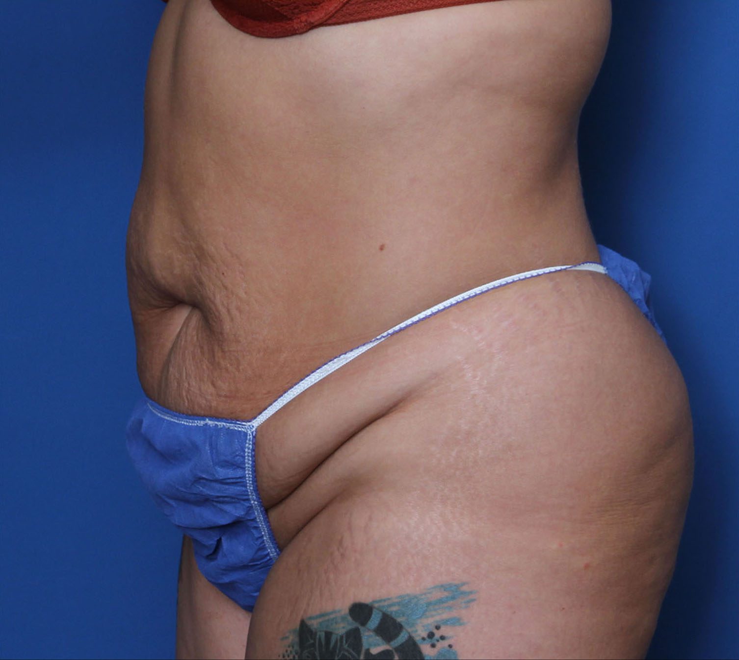 Tummy Tuck Patient Photo - Case 5534 - before view-1
