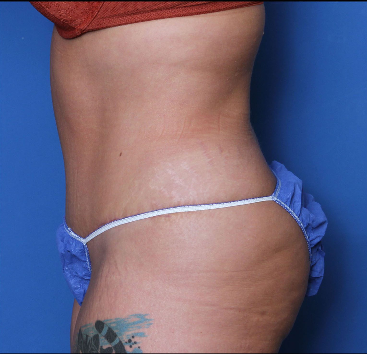 Tummy Tuck Patient Photo - Case 5534 - after view-2