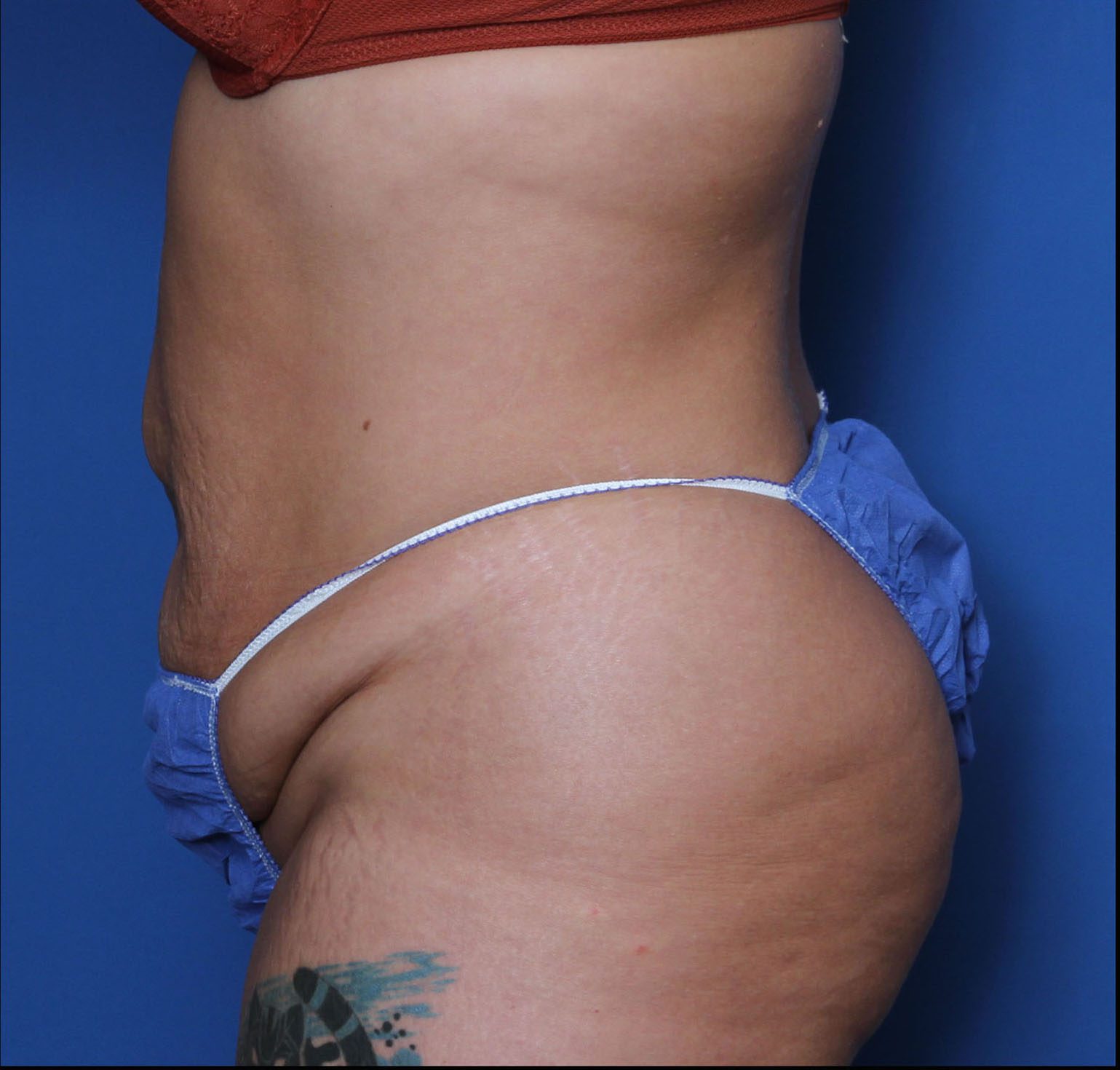 Tummy Tuck Patient Photo - Case 5534 - before view-2