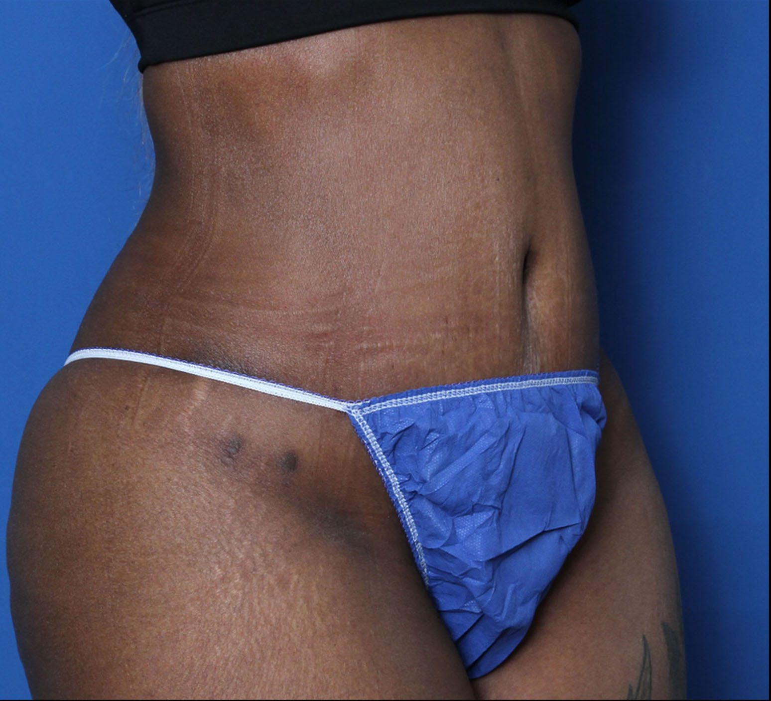 Tummy Tuck Patient Photo - Case 5542 - after view-1