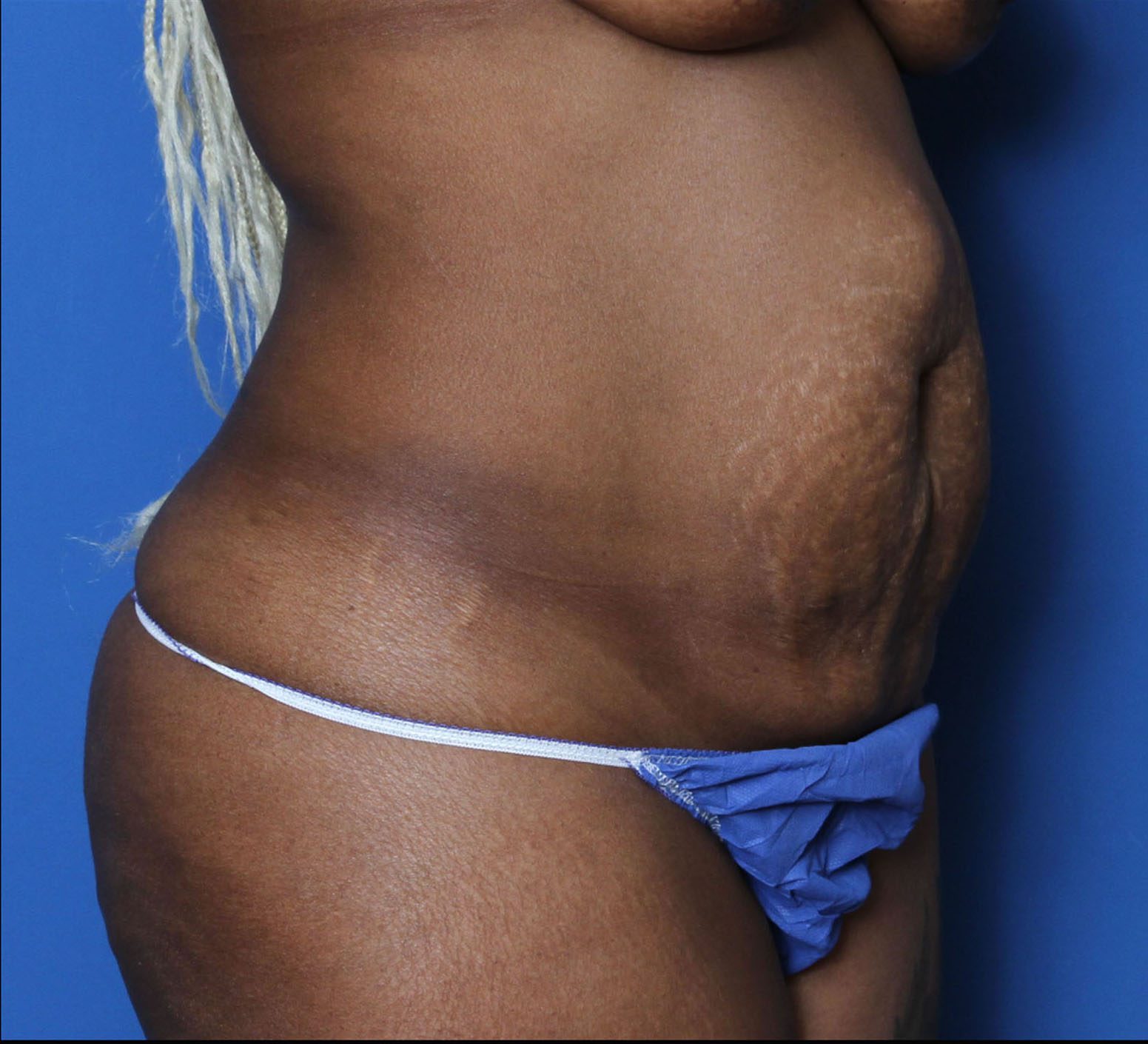 Tummy Tuck Patient Photo - Case 5542 - before view-1