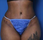 Tummy Tuck - Case 5542 - After