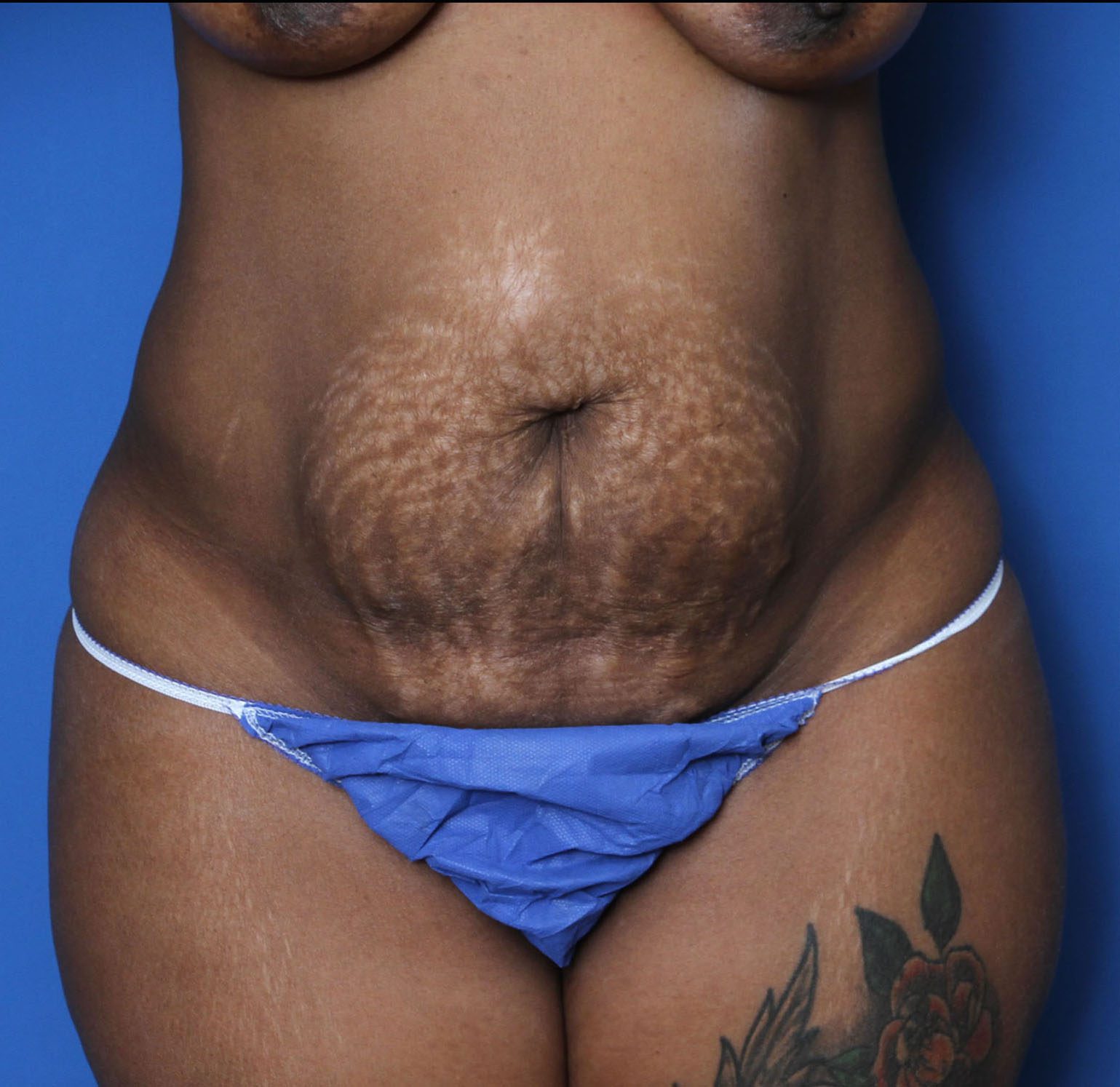 Tummy Tuck Patient Photo - Case 5542 - before view-0