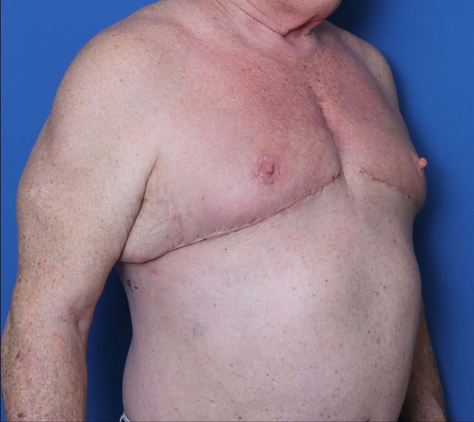 Gynecomastia Patient Photo - Case 5550 - after view-1