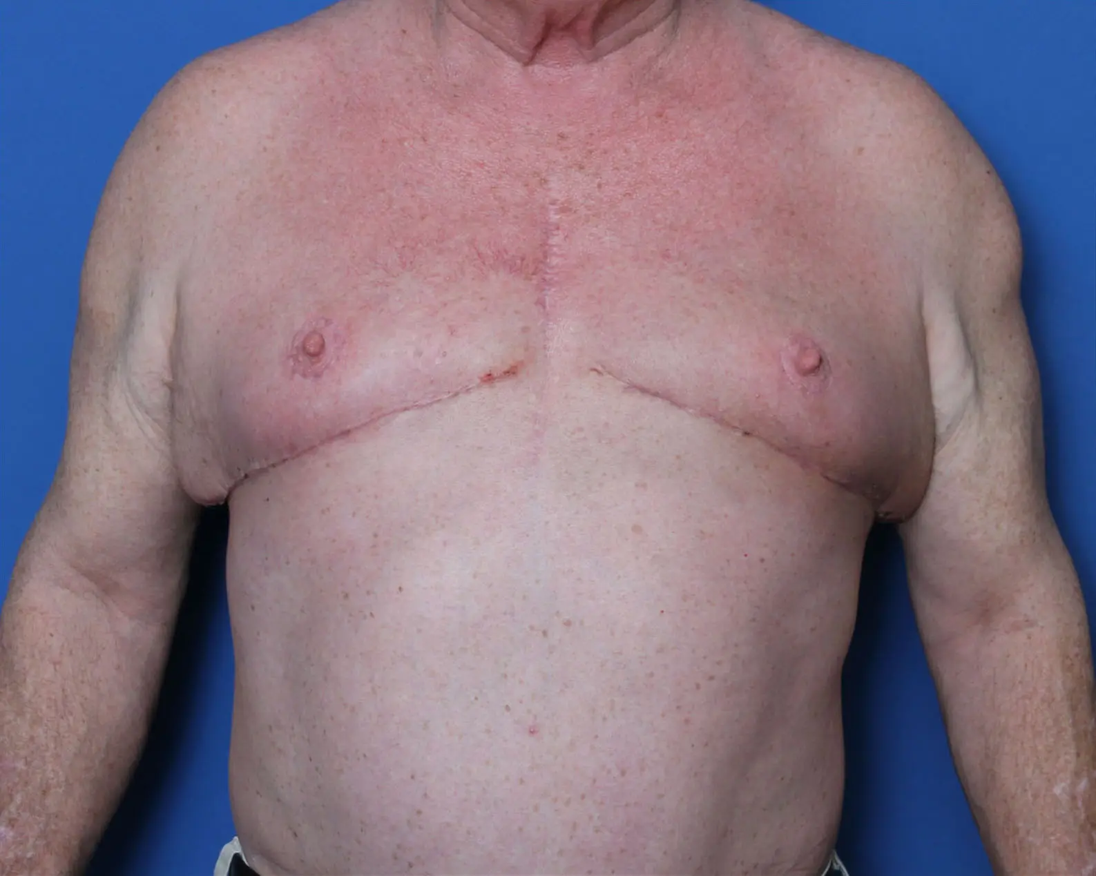Gynecomastia/Male Chest Lift - Case 5550 - After
