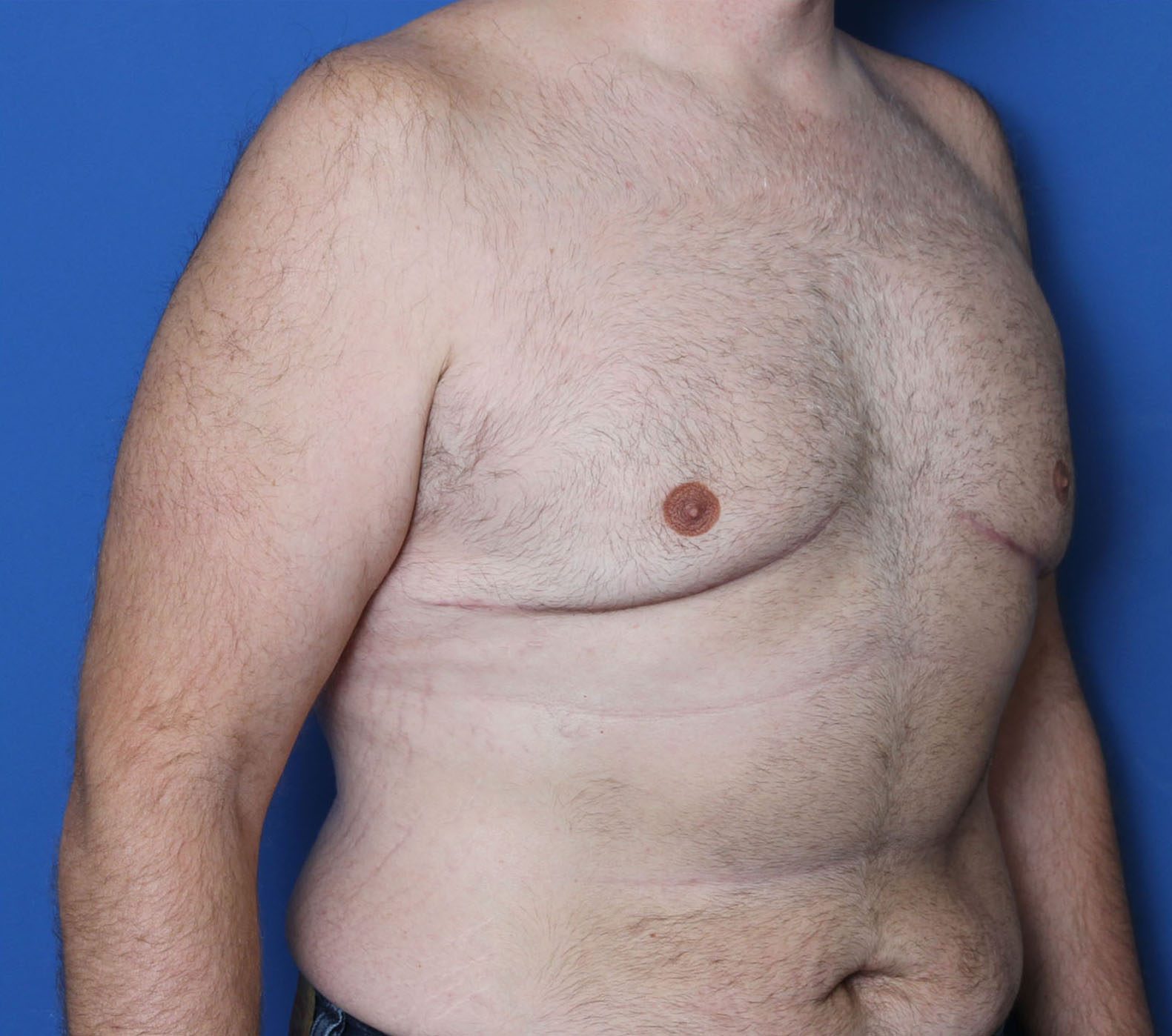 Gynecomastia Patient Photo - Case 5564 - after view-1