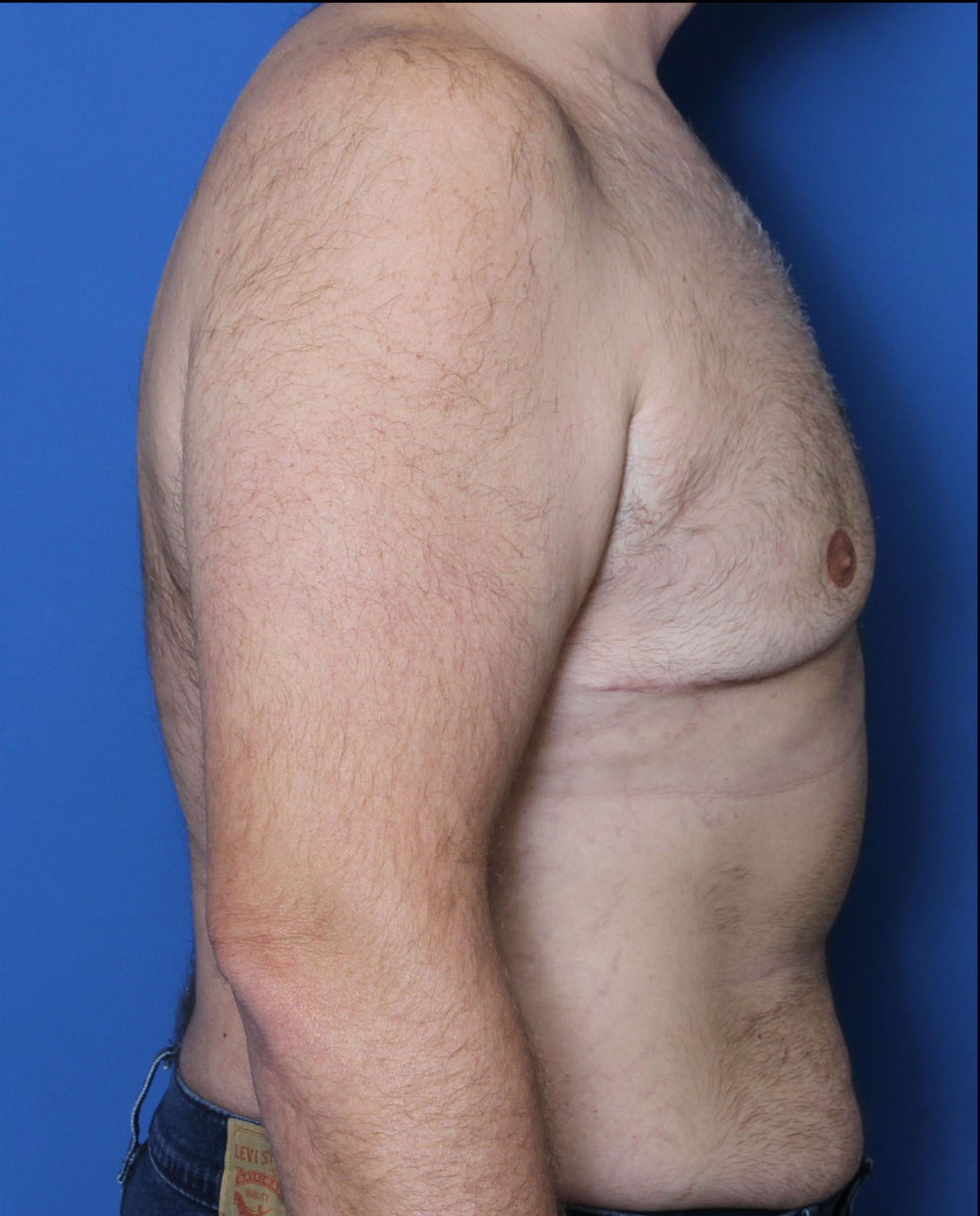Gynecomastia Patient Photo - Case 5564 - after view-2