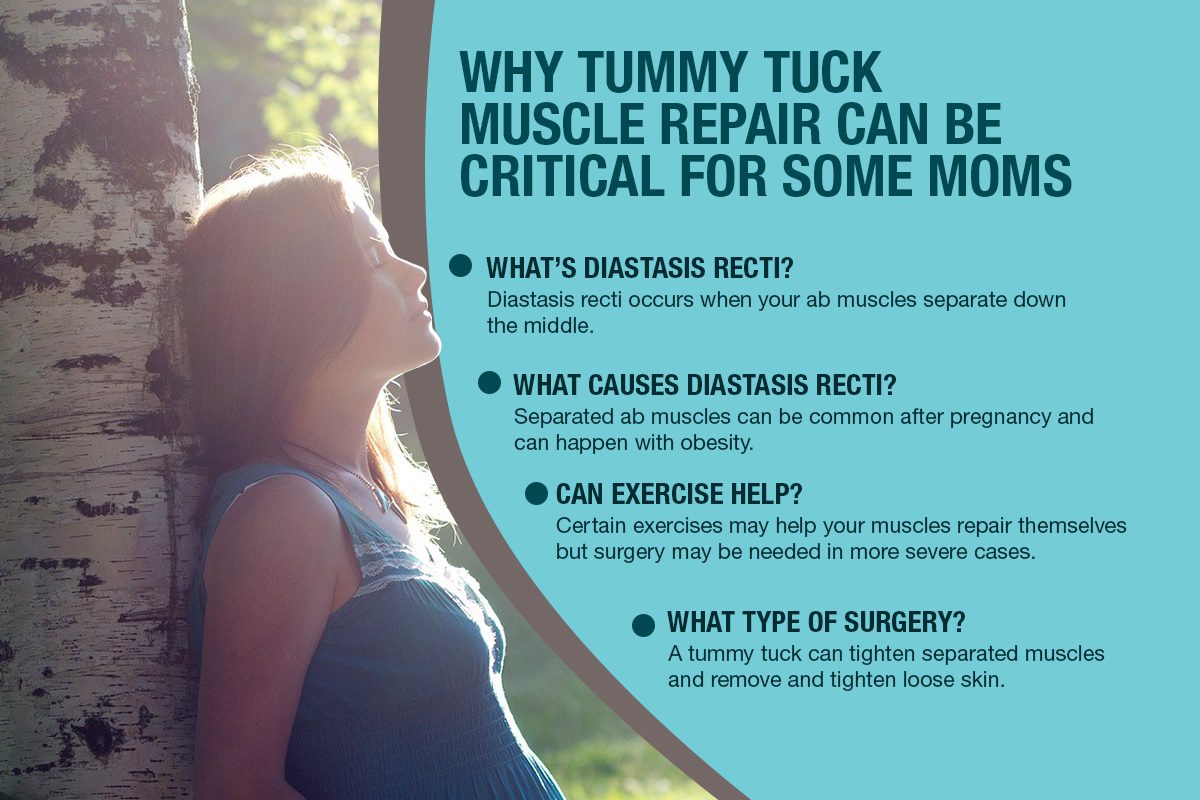 Why Tummy Tuck Muscle Repair Can Be Critical For Some Moms
