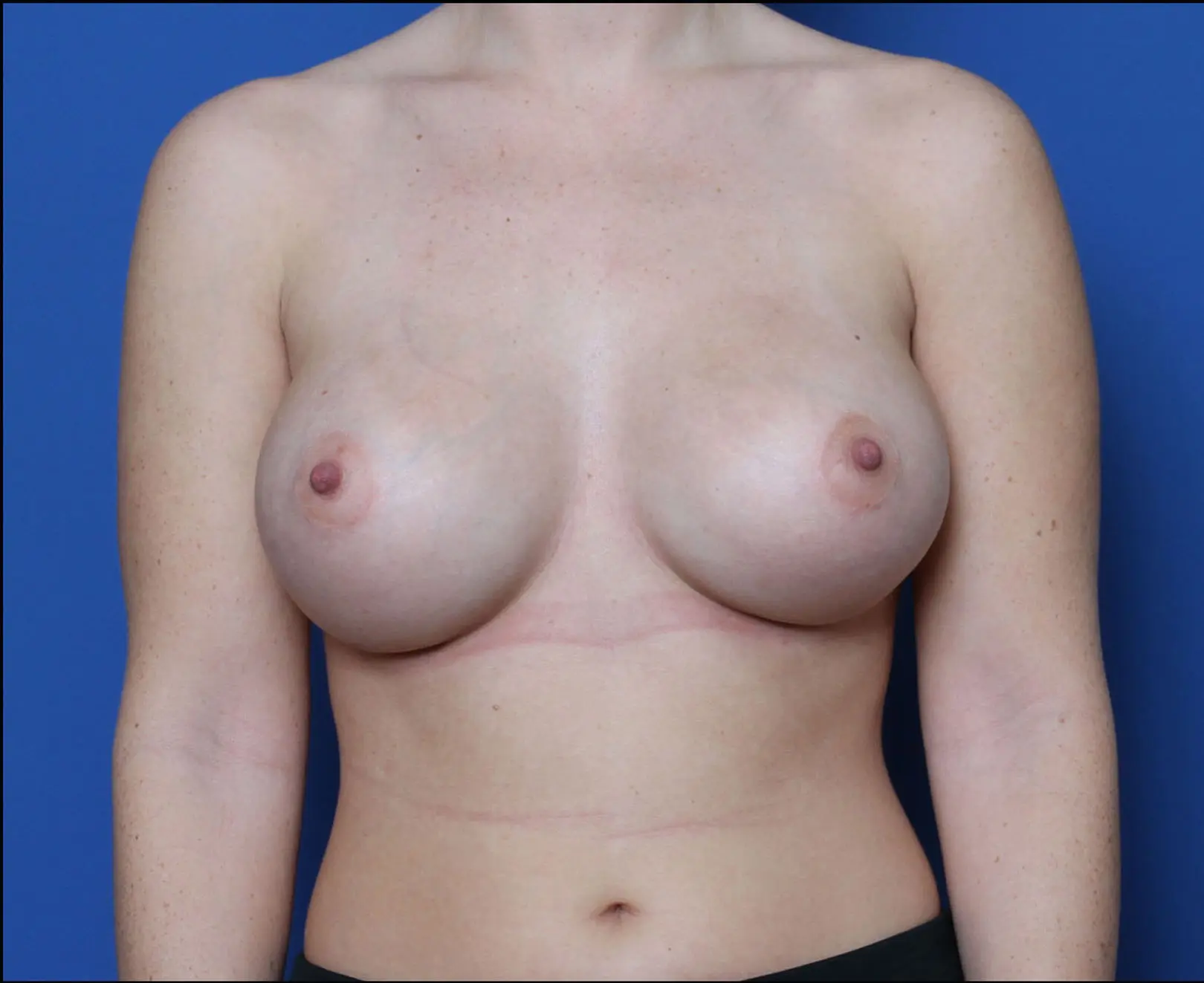 Breast Augmentation Patient Photo - Case 6091 - after view
