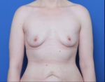 Breast Augmentation - Case 6978 - Before