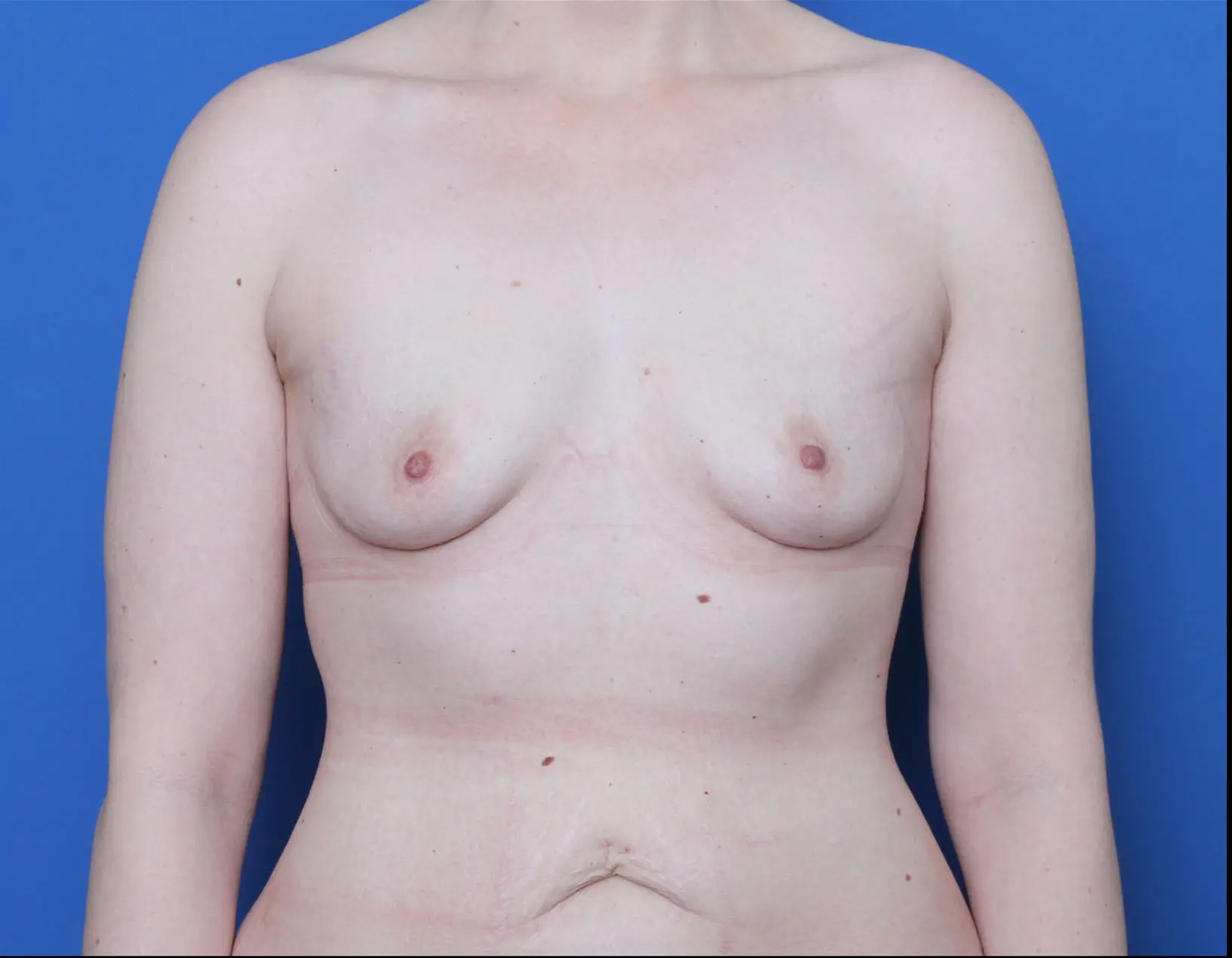 Breast Augmentation Patient Photo - Case 6978 - before view-0