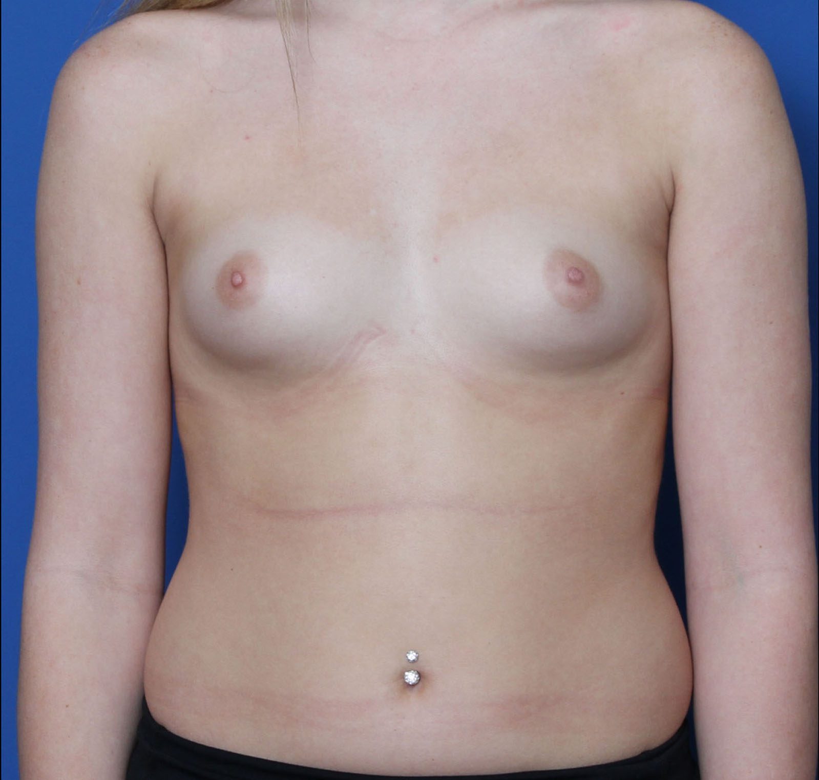Breast Augmentation/Lift Patient Photo - Case 8166 - before view-