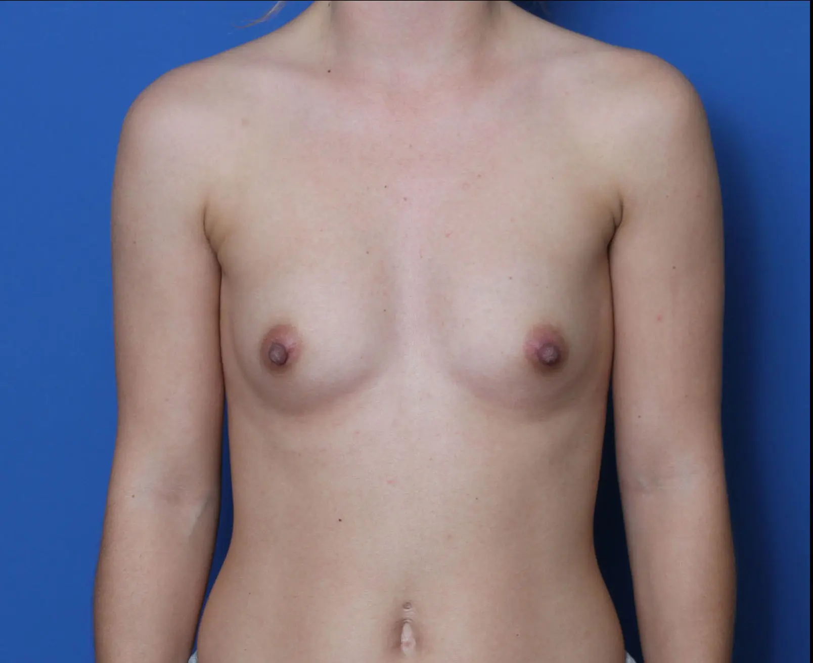 Breast Augmentation Patient Photo - Case 9488 - before view-