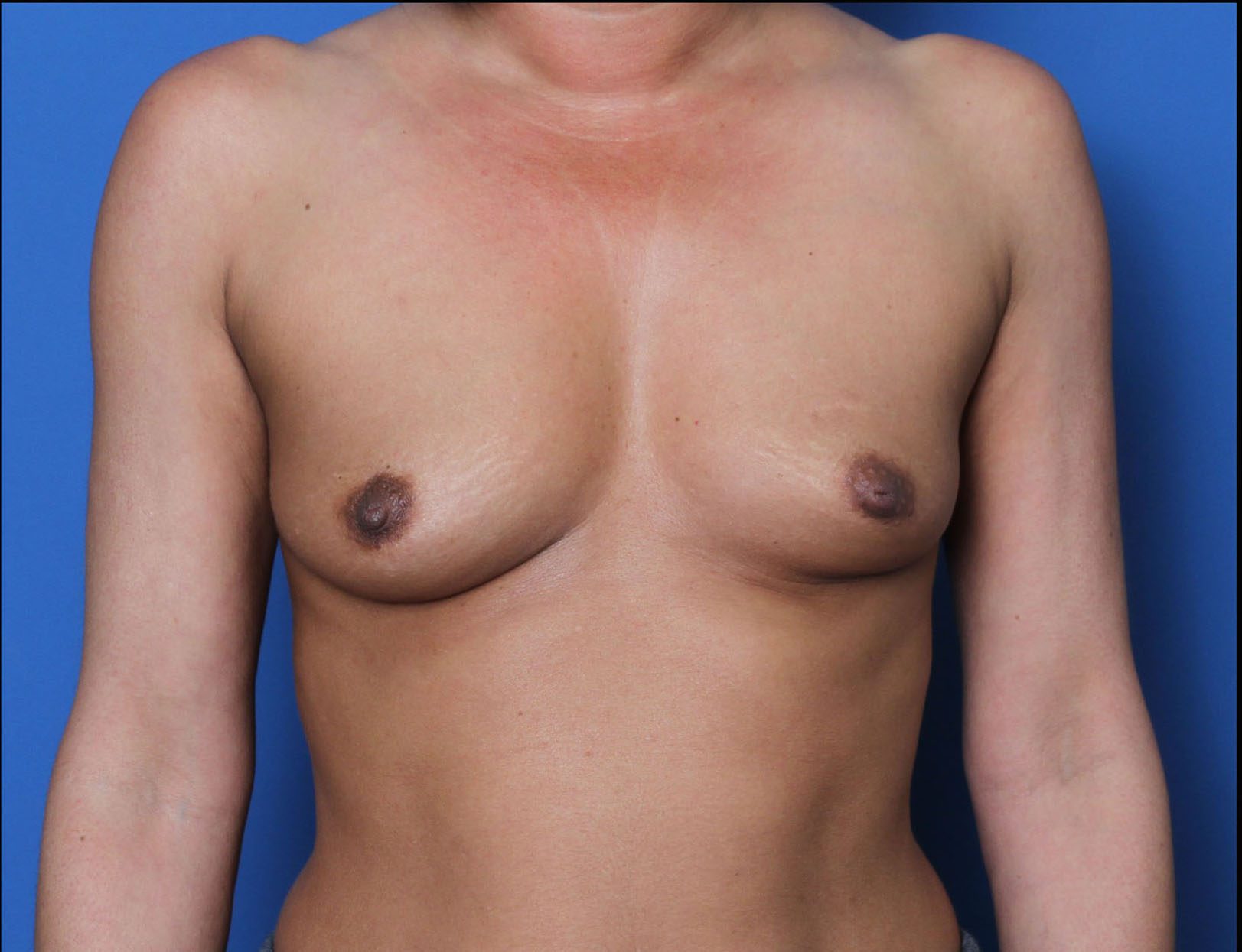 Breast Augmentation Patient Photo - Case MM4537 - before view-0