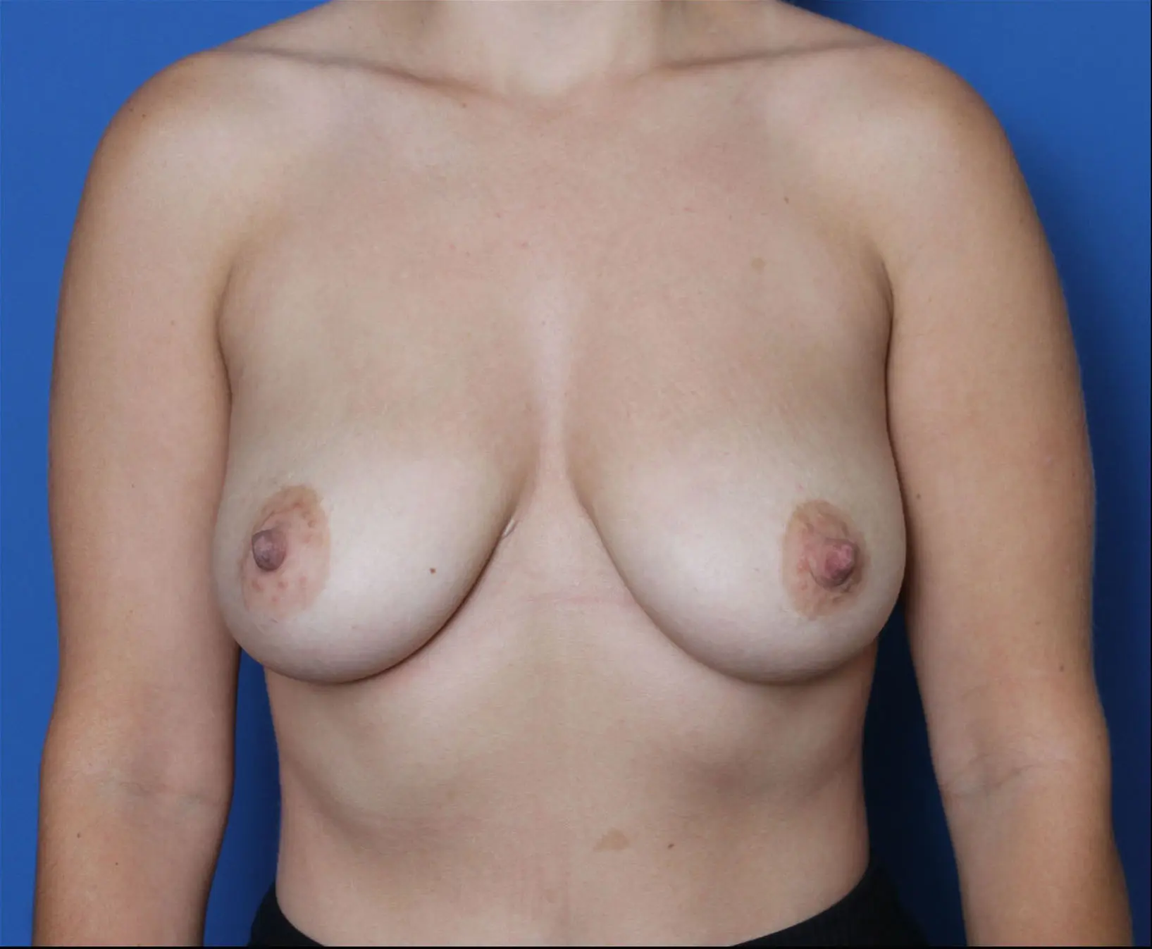 Breast Augmentation Patient Photo - Case MM4880 - before view-0