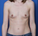 Breast Augmentation - Case MM9206 - Before