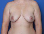 Breast Augmentation/Lift - Case 8625 - Before