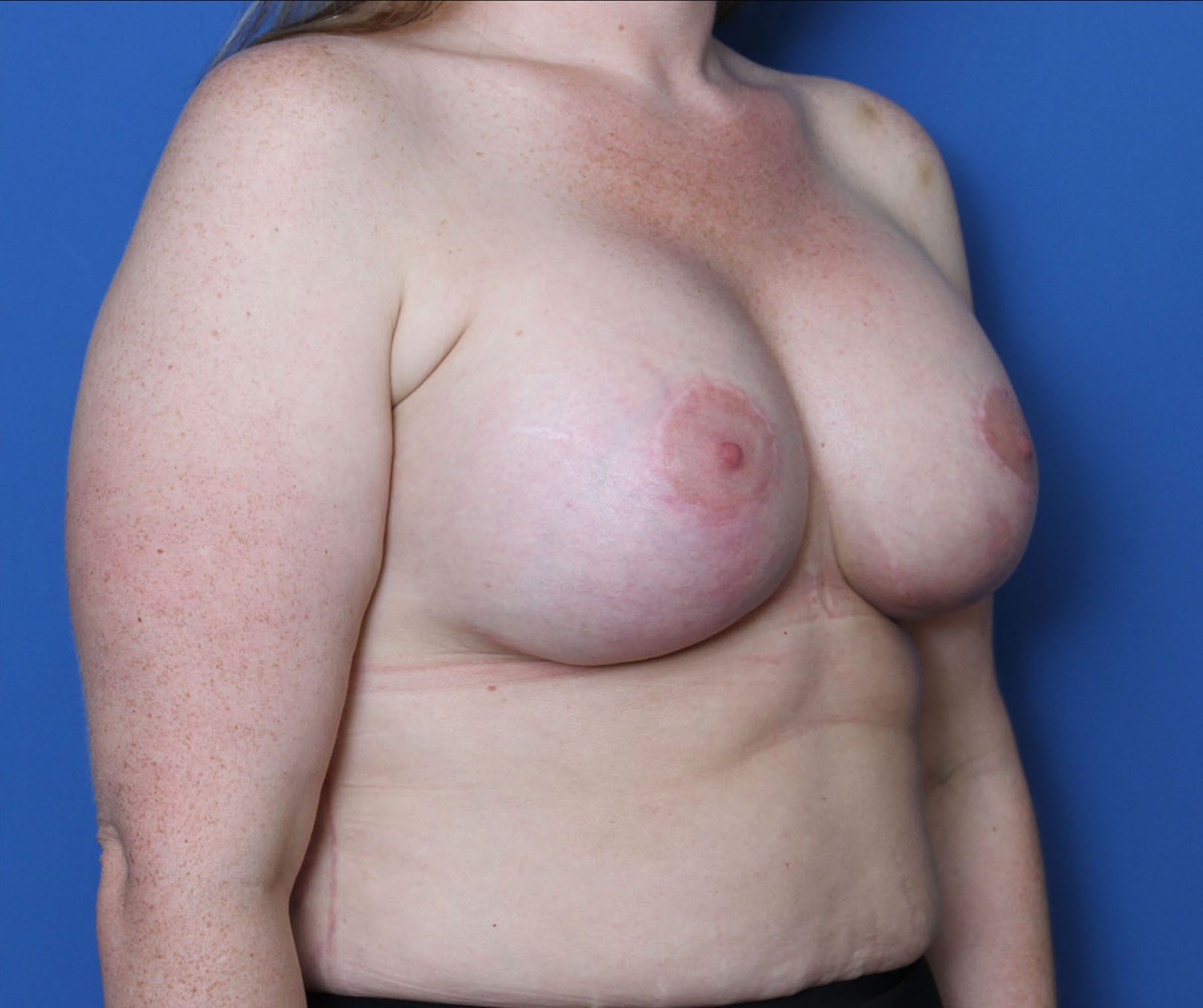Breast Augmentation/Lift Patient Photo - Case 10265 - after view-1