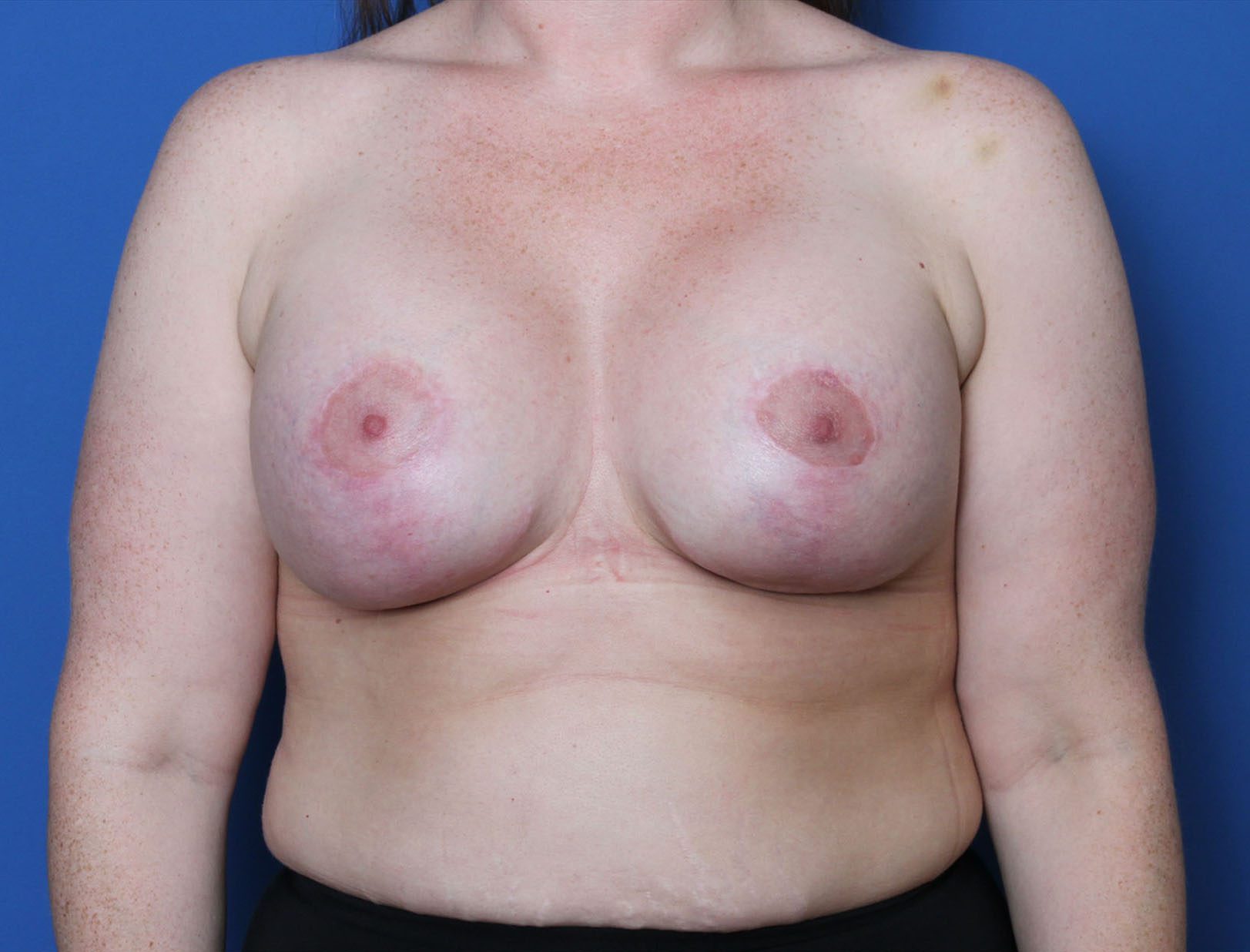 Breast Augmentation/Lift Patient Photo - Case 10265 - after view-0