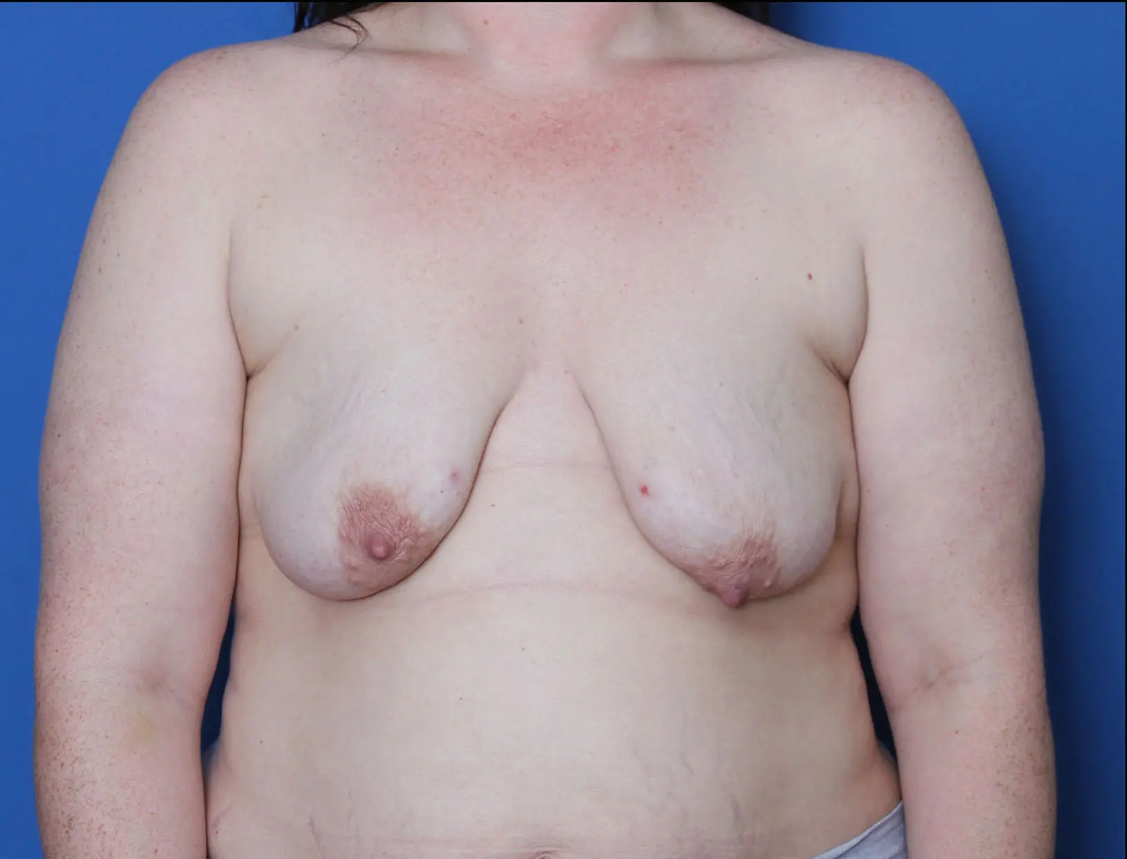 Breast Augmentation/Lift Patient Photo - Case 10265 - before view-0