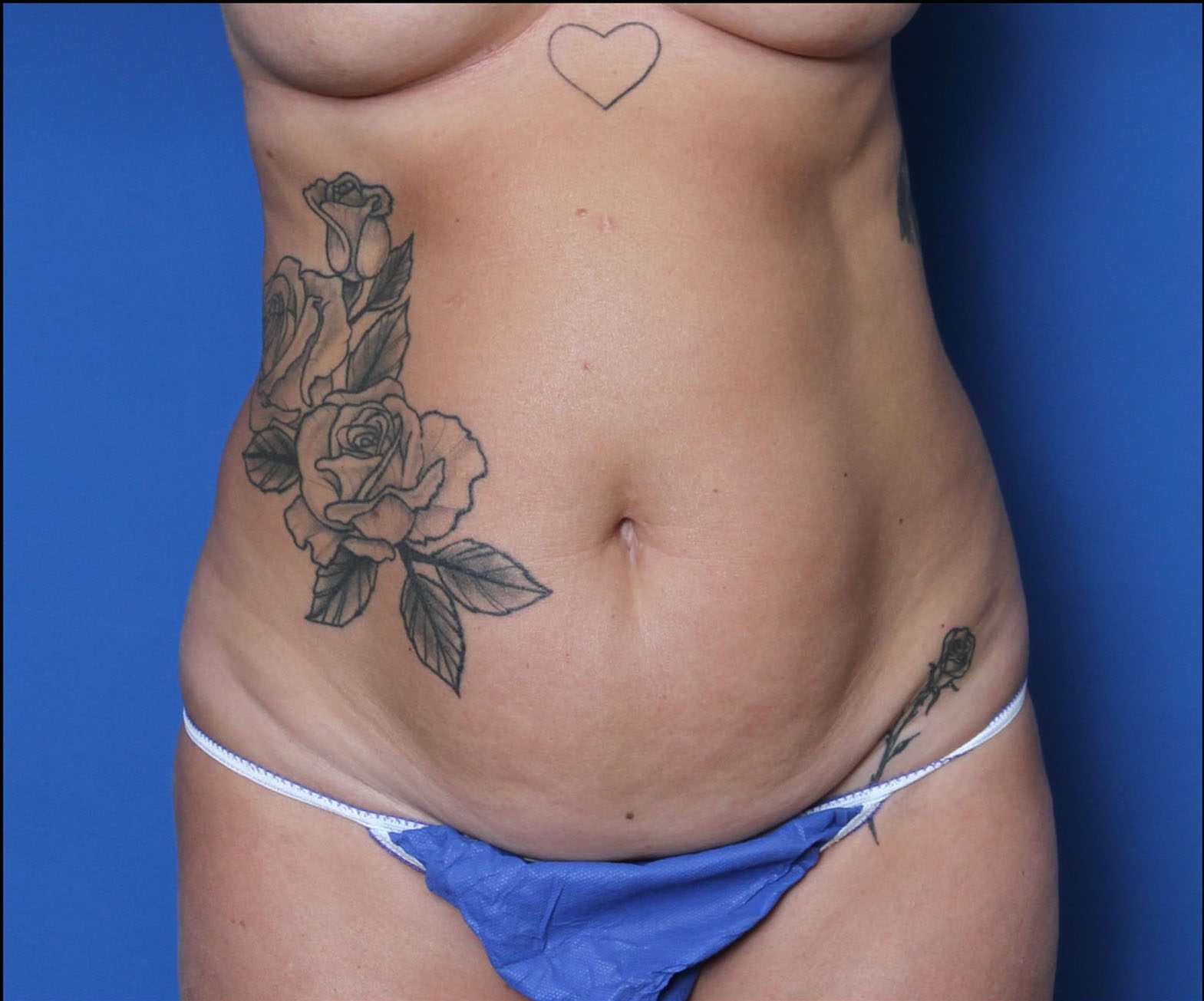 Liposuction Patient Photo - Case MM4924 - before view-0
