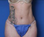 Liposuction - Case MM4924 - After
