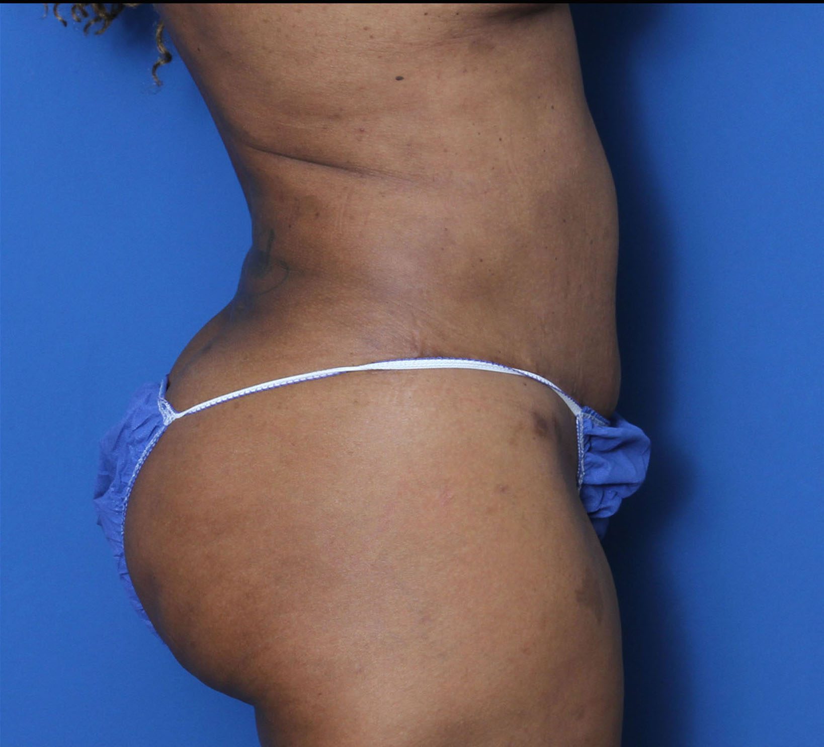 Liposuction Patient Photo - Case 8927 - after view-2
