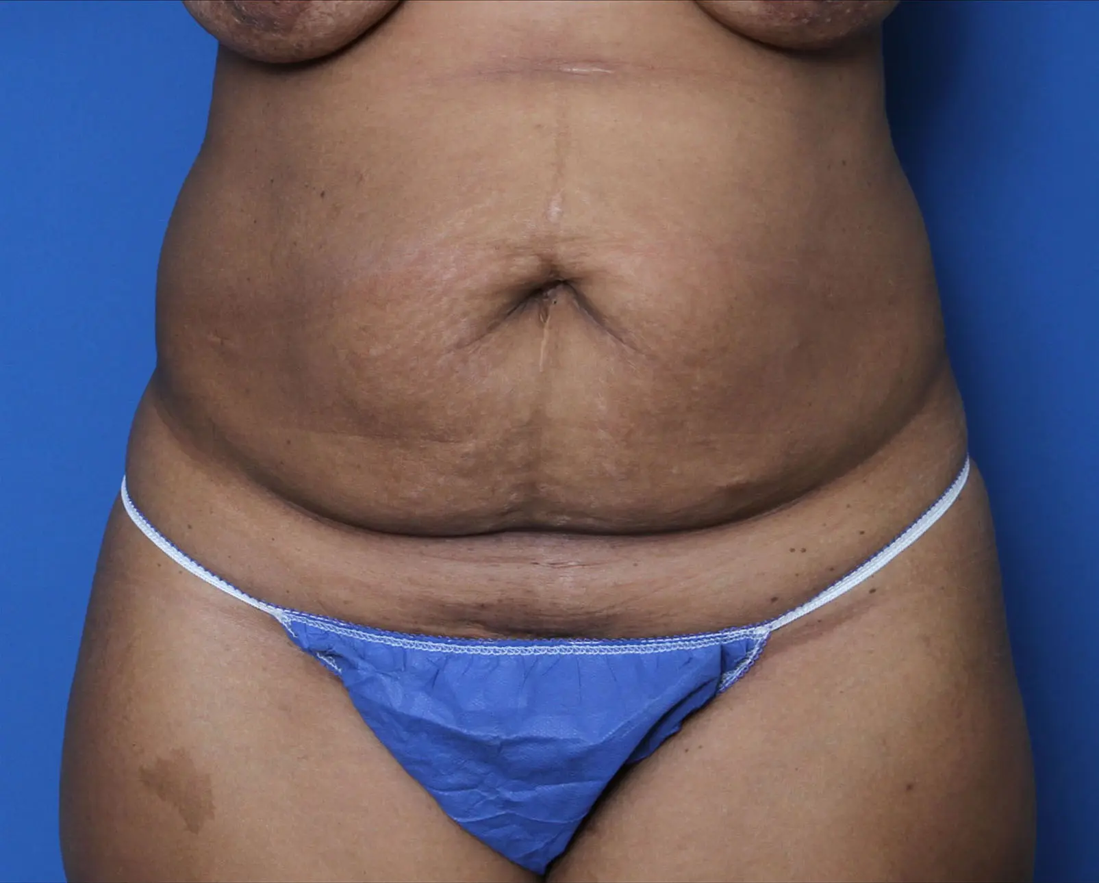 Liposuction Patient Photo - Case 8927 - before view-0