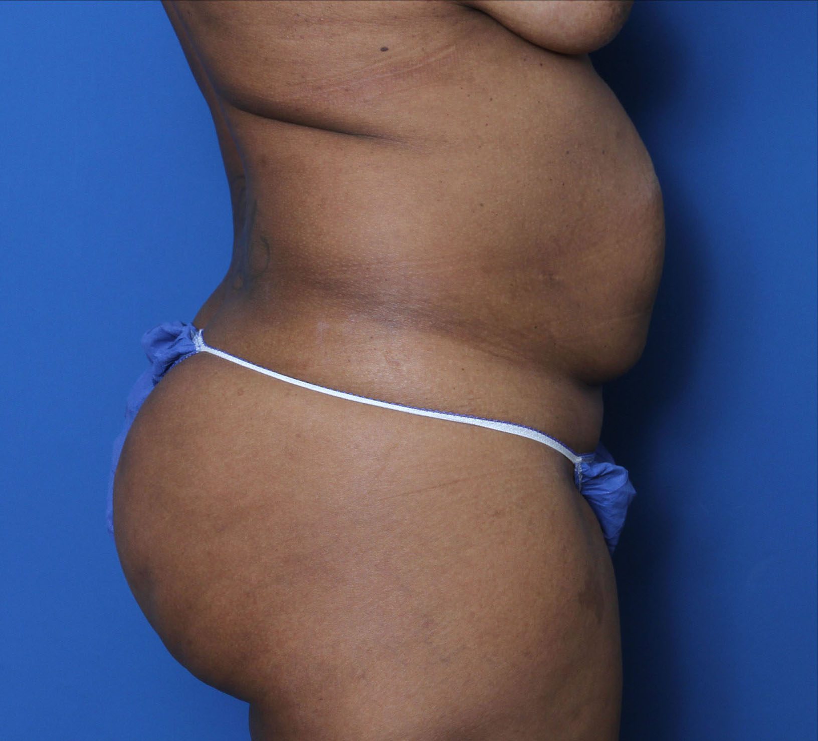 Liposuction Patient Photo - Case 8927 - before view-2