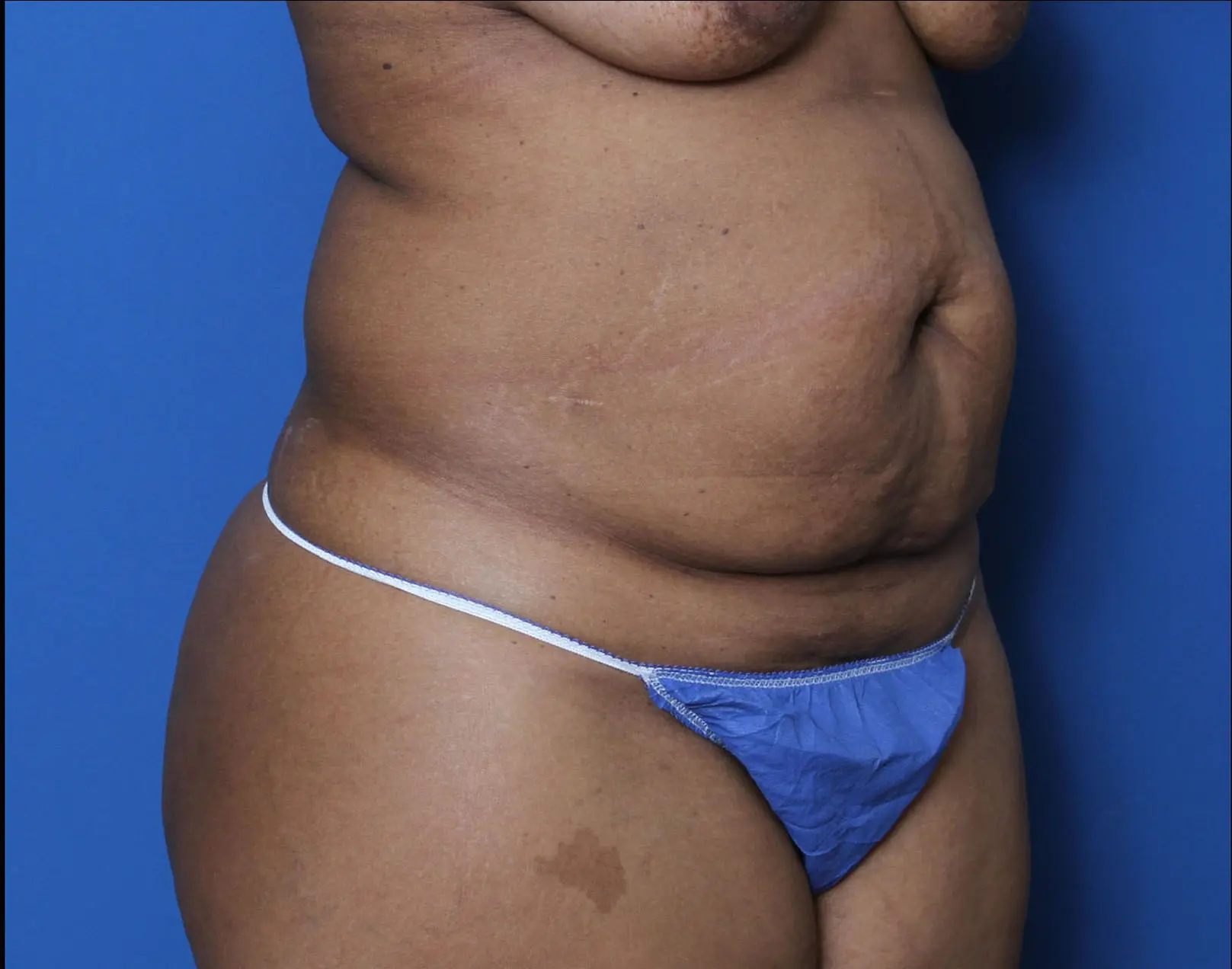 Liposuction Patient Photo - Case 8927 - before view-1