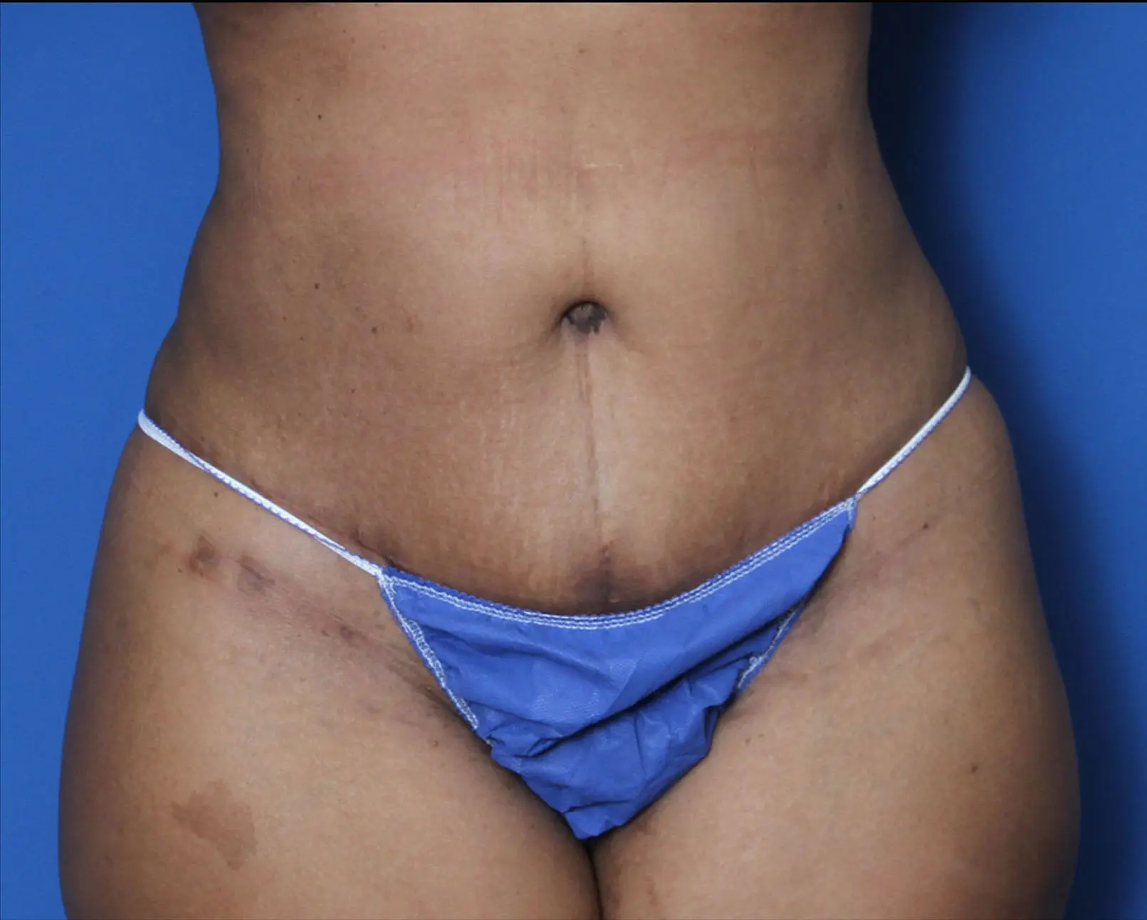 Liposuction Patient Photo - Case 8927 - after view-0