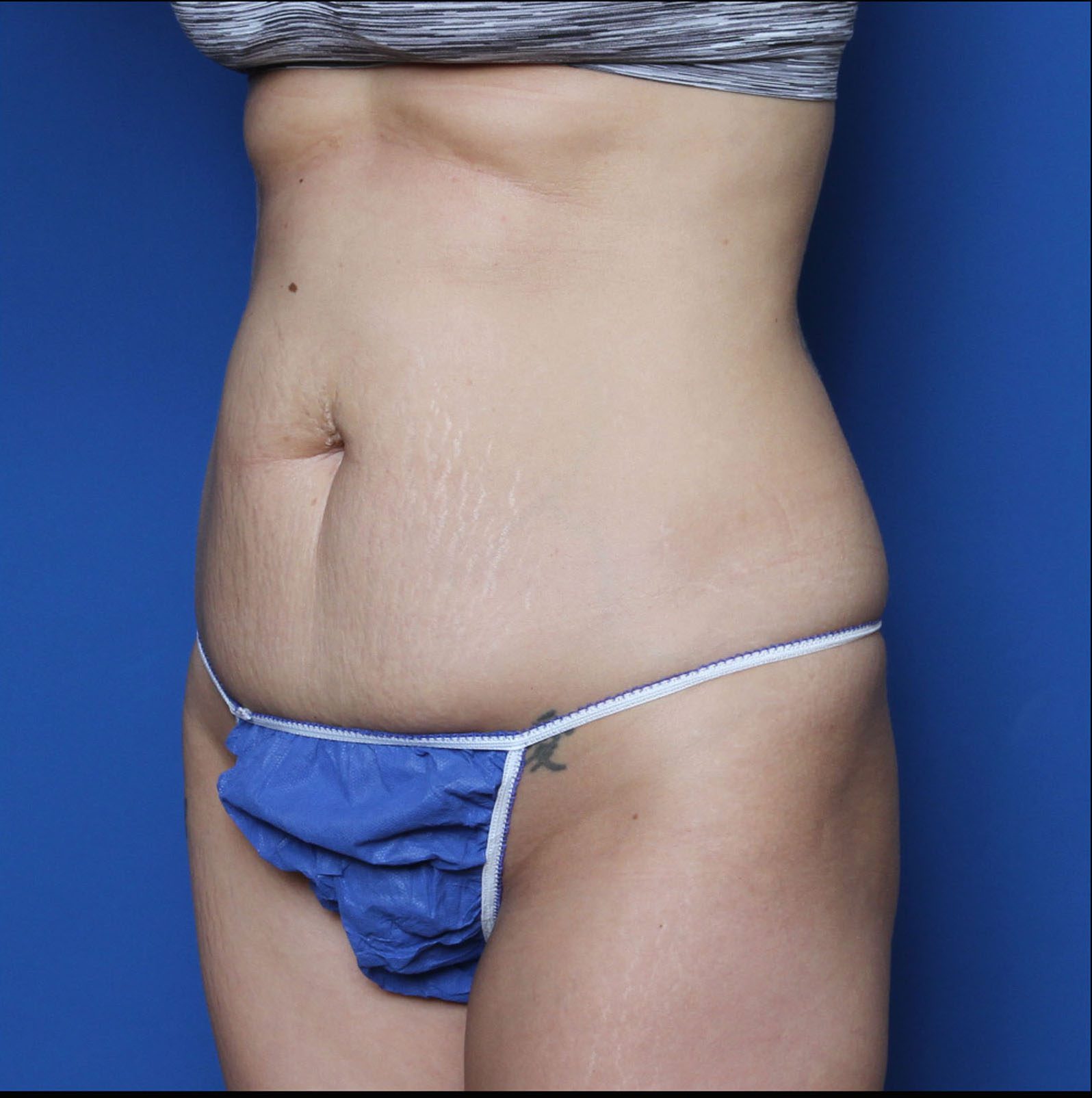 Liposuction Patient Photo - Case 6919 - before view-1