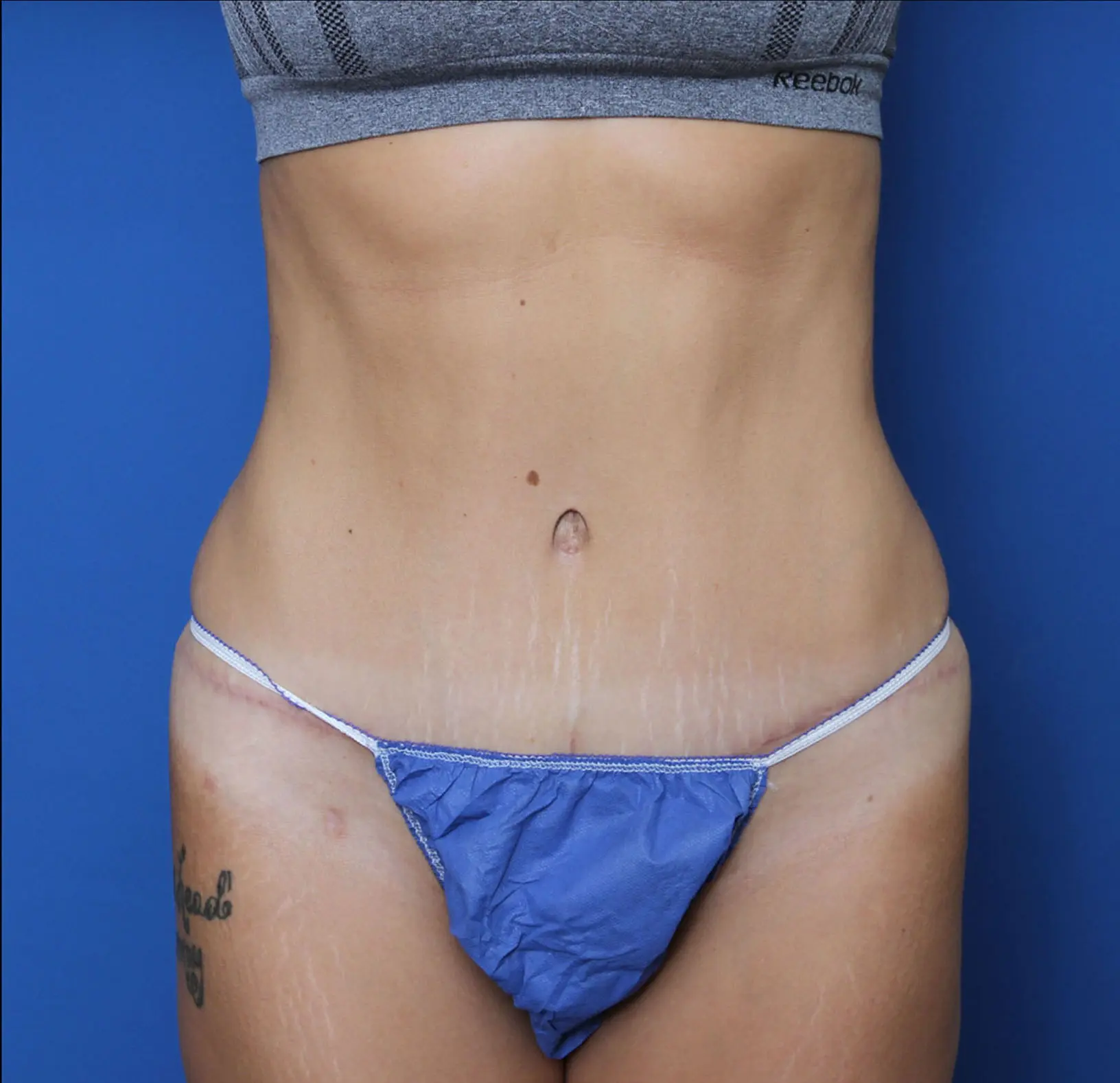 Liposuction Patient Photo - Case 6919 - after view-0