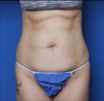 Liposuction - Case 6919 - Before