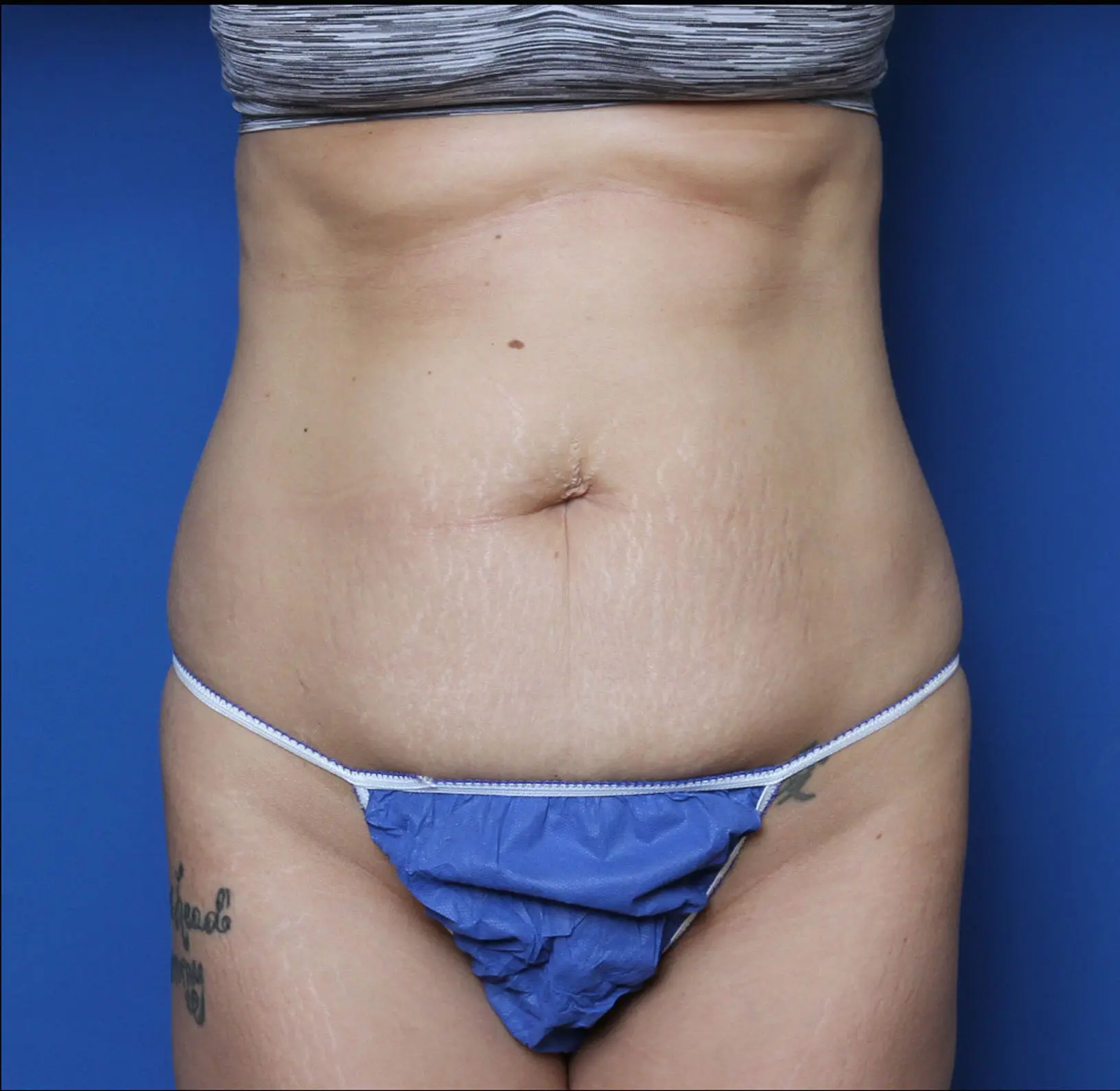 Liposuction Patient Photo - Case 6919 - before view-