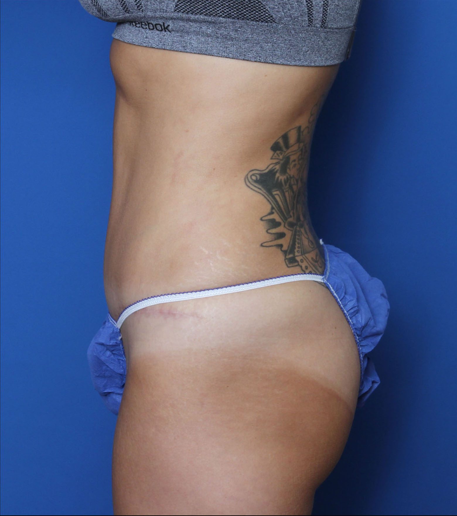 Liposuction Patient Photo - Case 6919 - after view-2