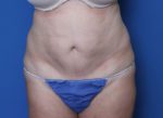 Liposuction - Case 9144 - Before