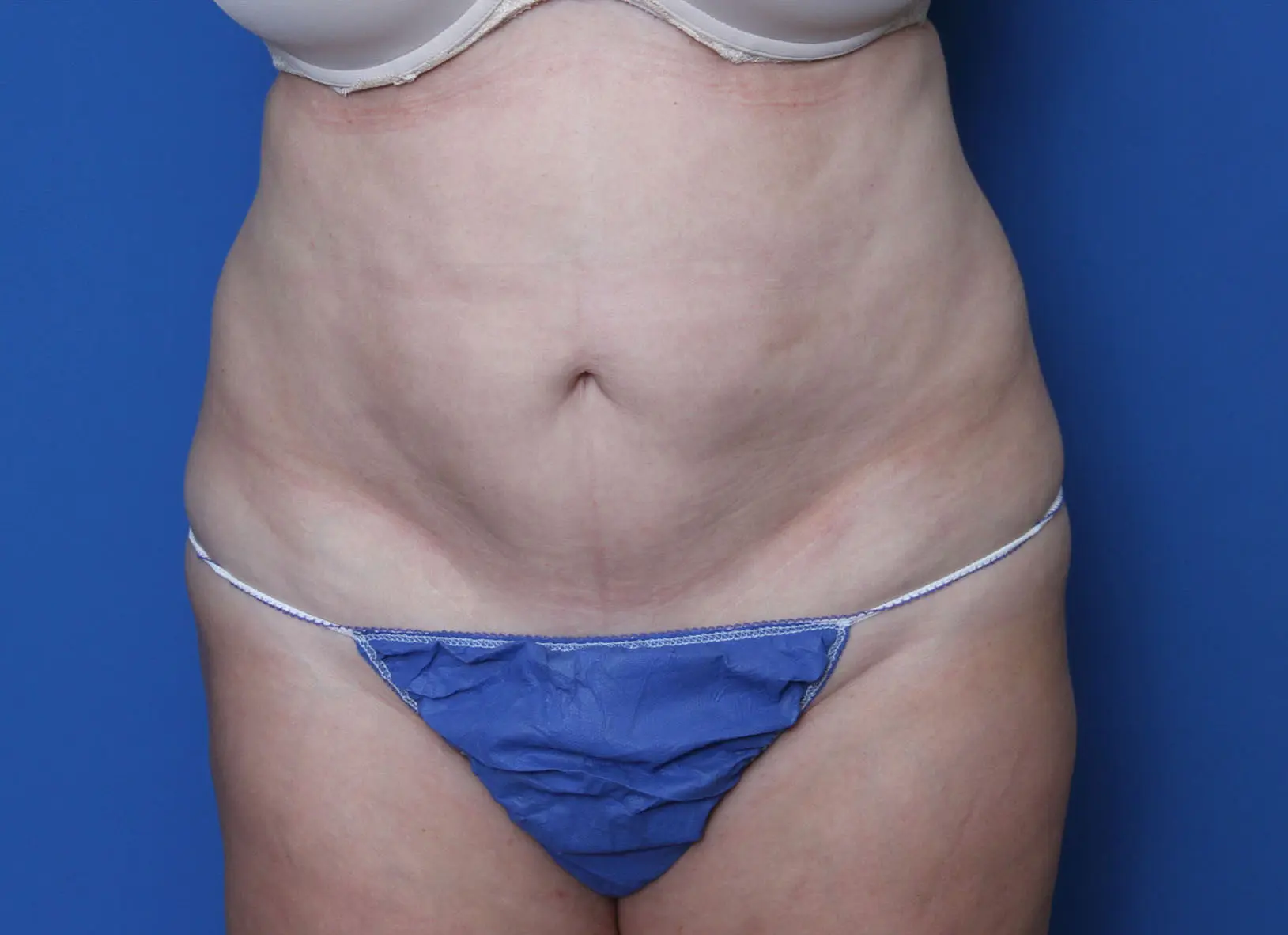 Liposuction Patient Photo - Case 9144 - before view-