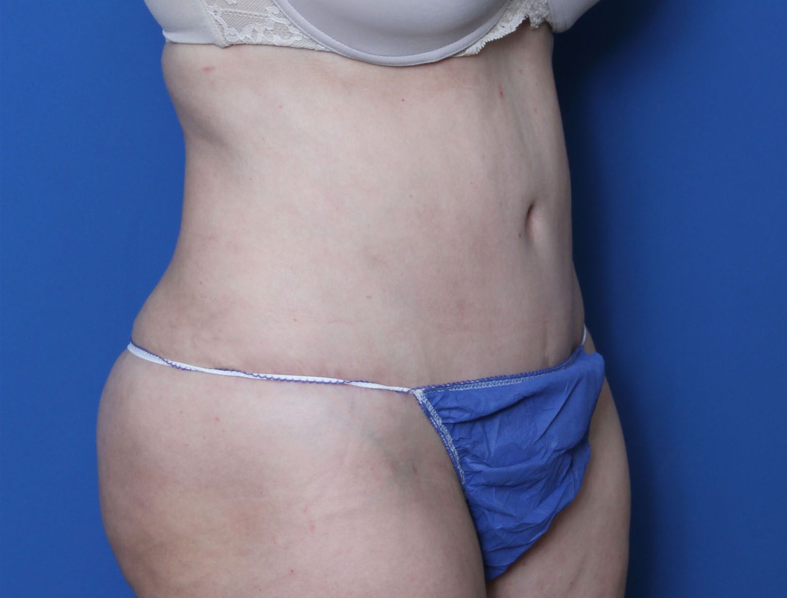 Liposuction Patient Photo - Case 9144 - after view-1